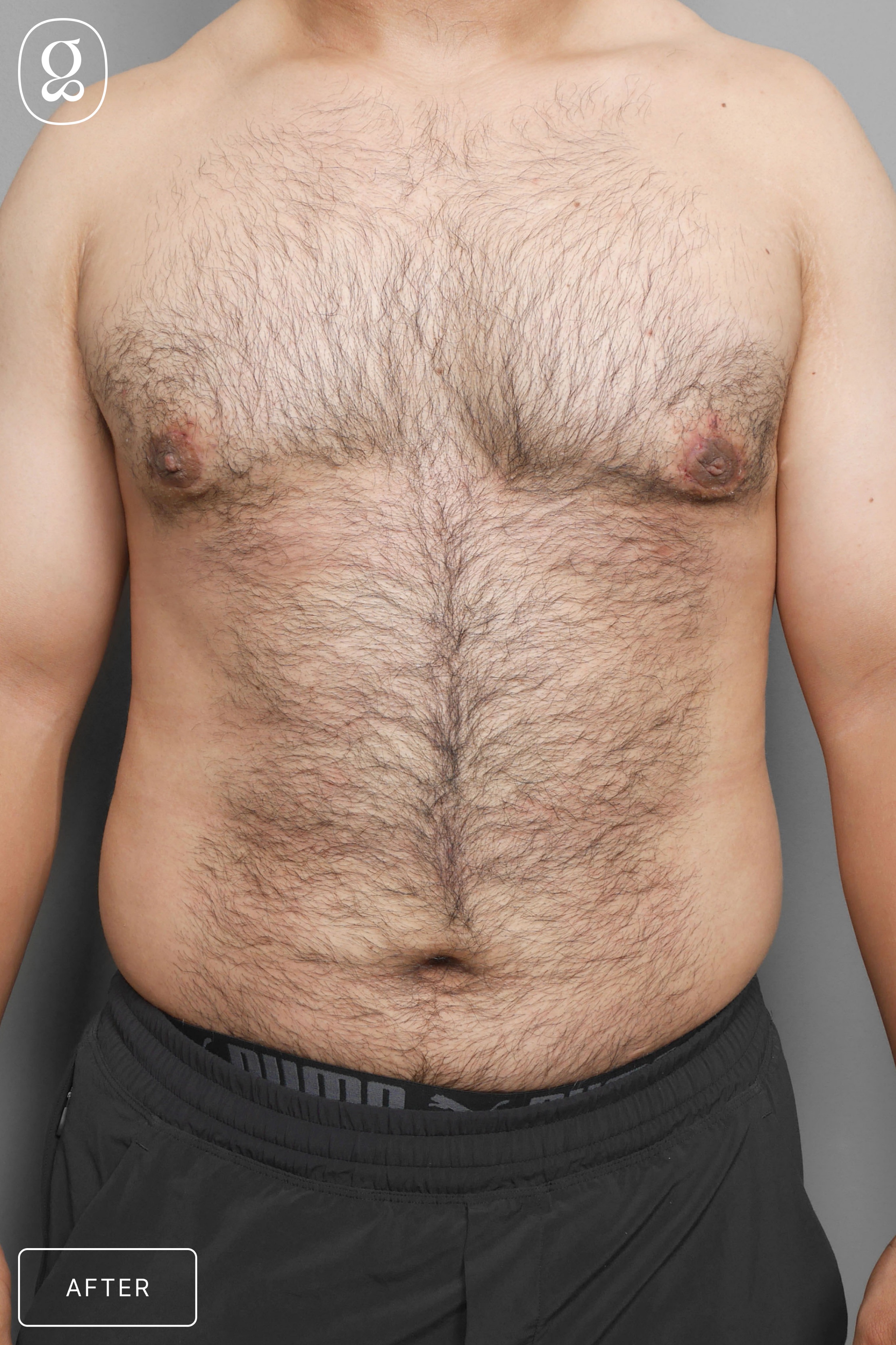 Gynecomastia result at Gould Aesthetics