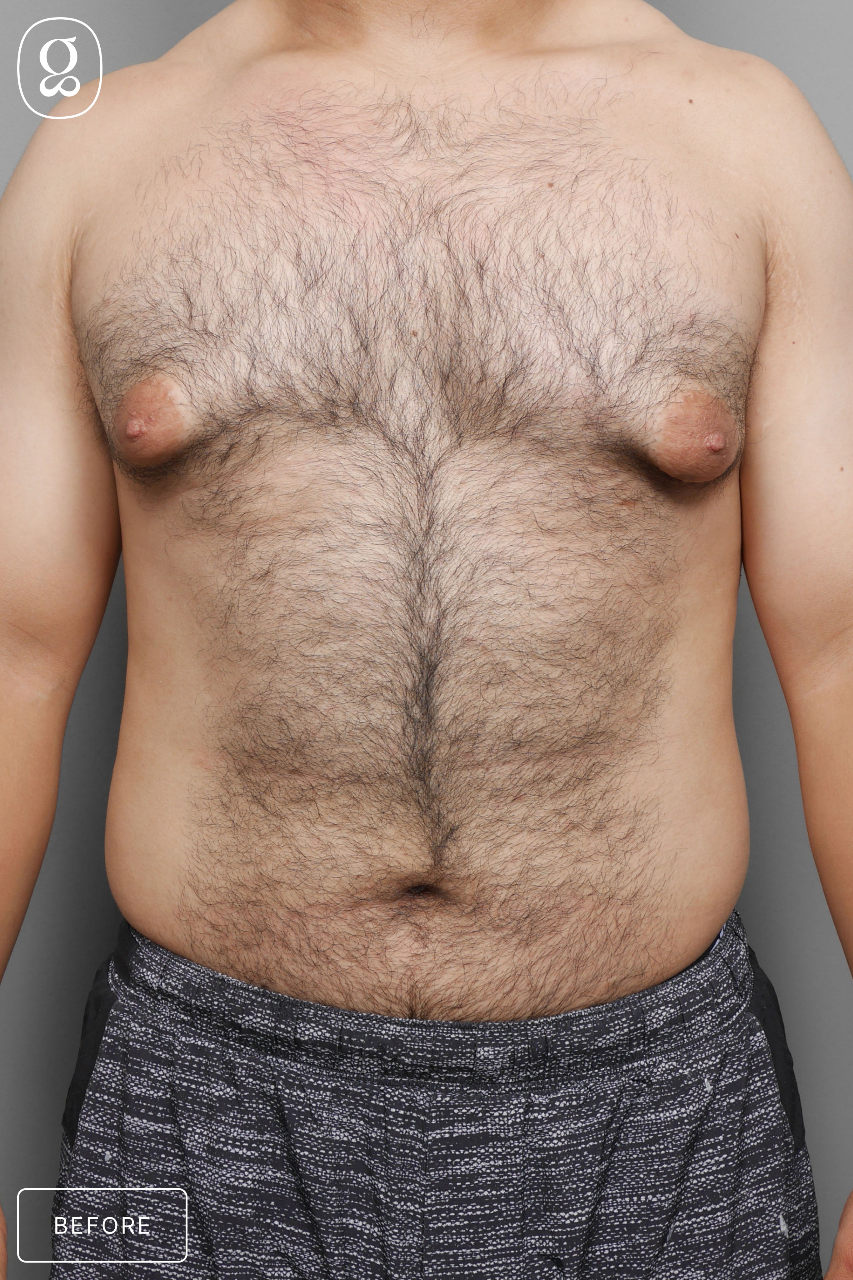 Gynecomastia before photo