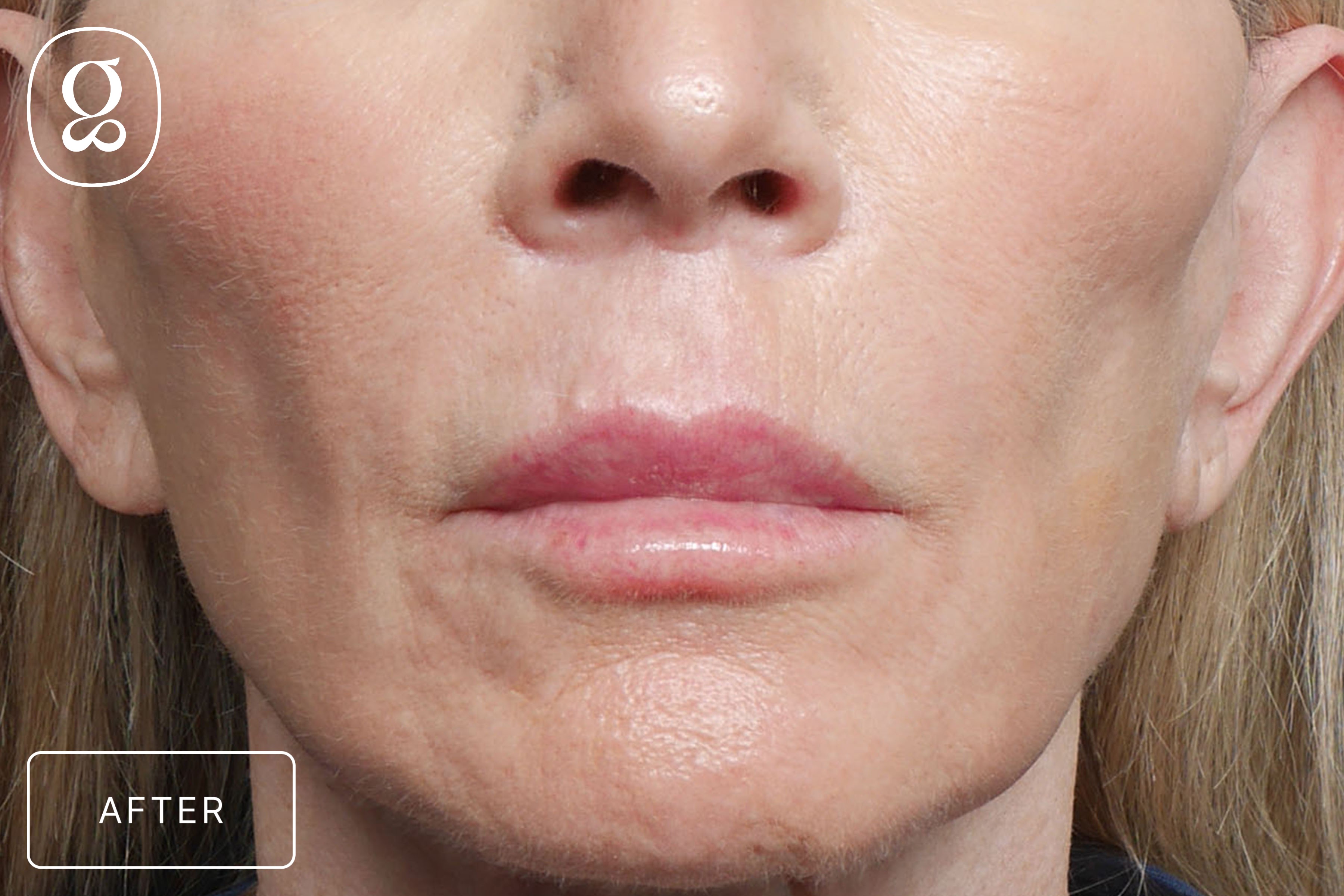 Lip Lift result at Gould Aesthetics