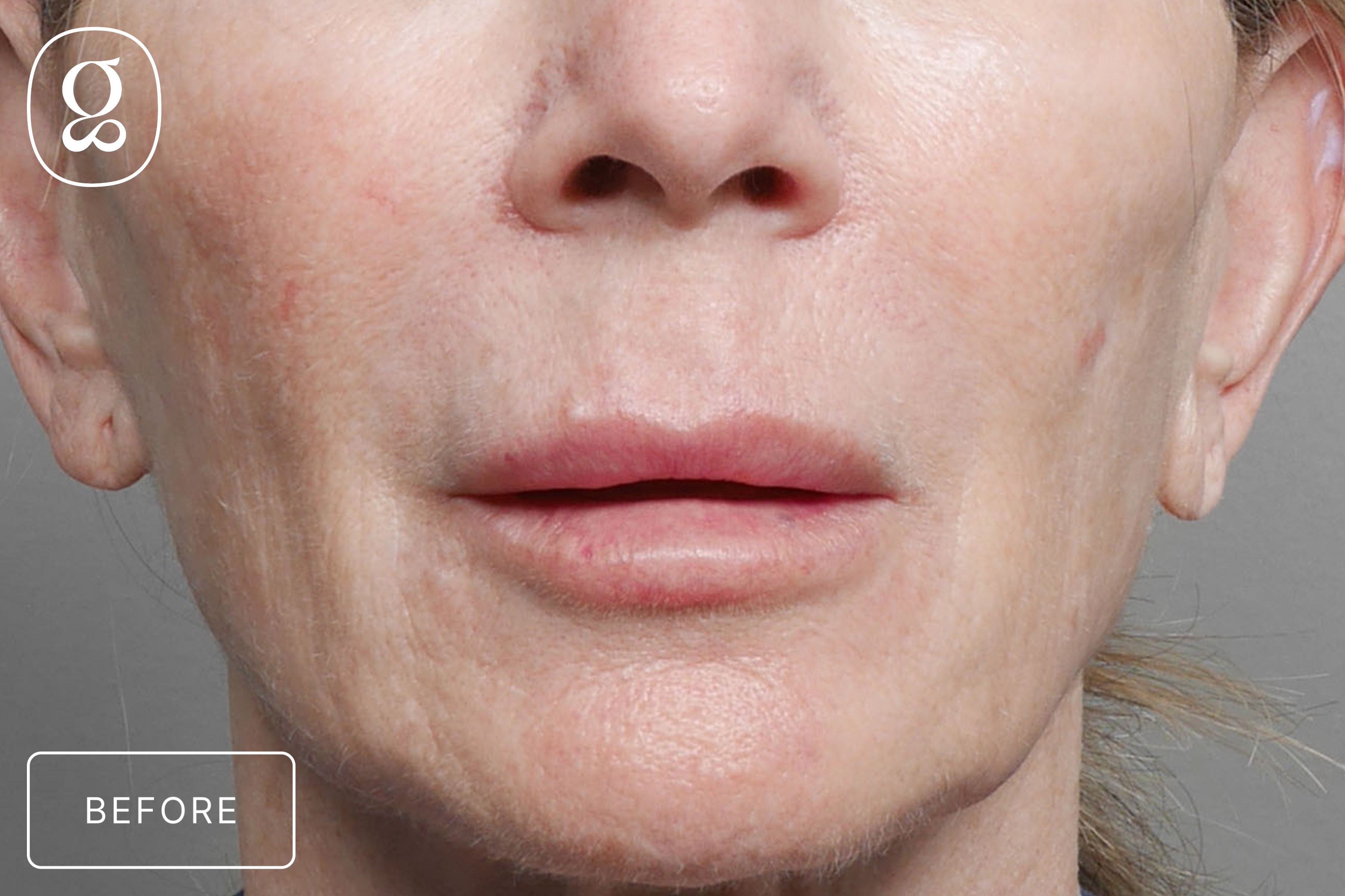 Lip Lift before photo
