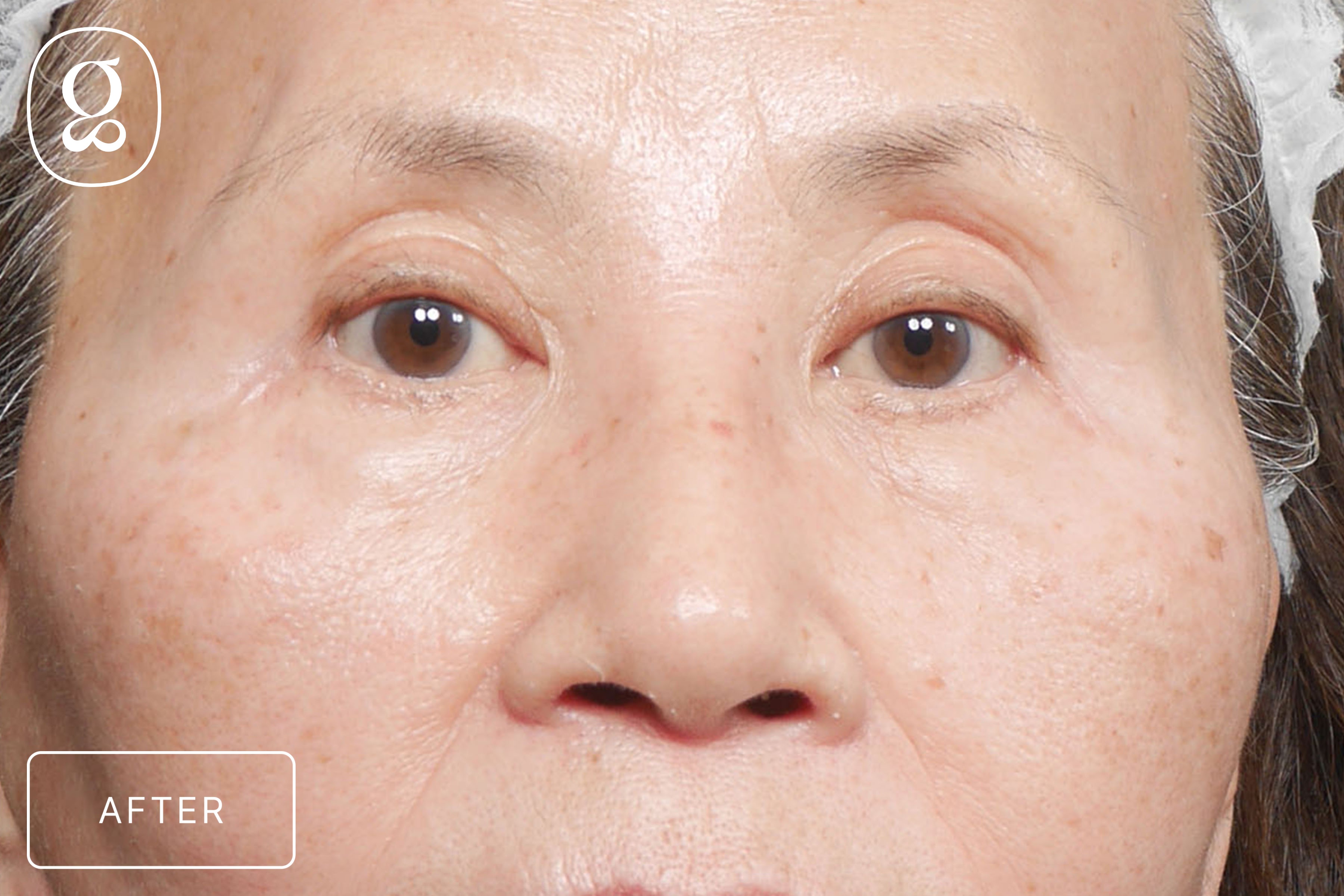 Blepharoplasty result at Gould Aesthetics