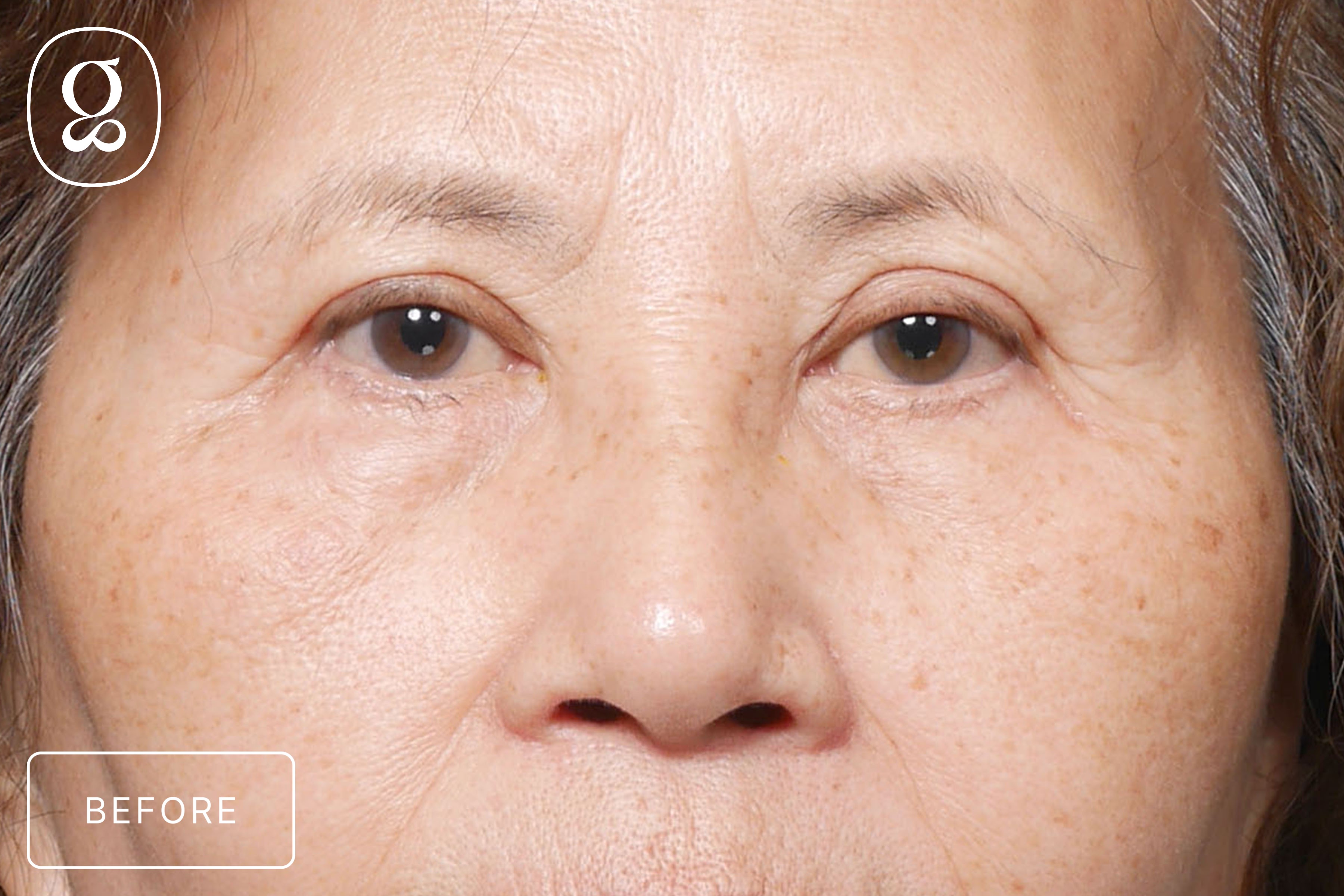 Blepharoplasty before photo