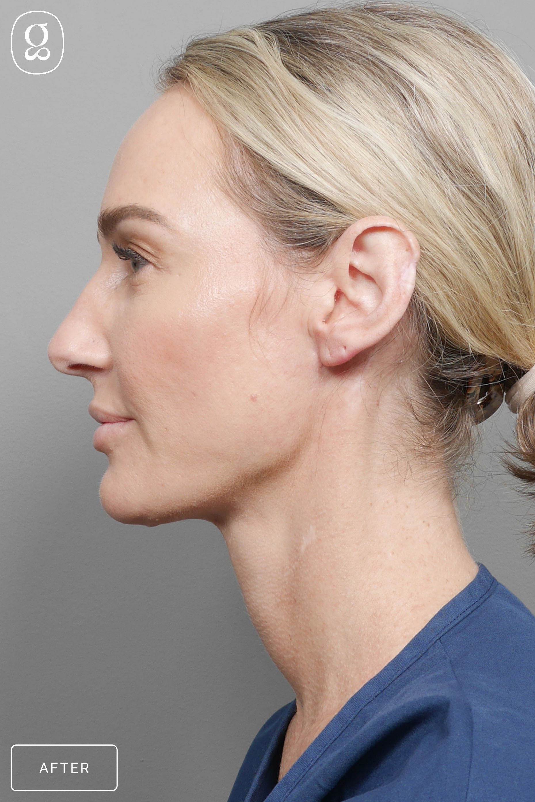 Facelift result at Gould Aesthetics