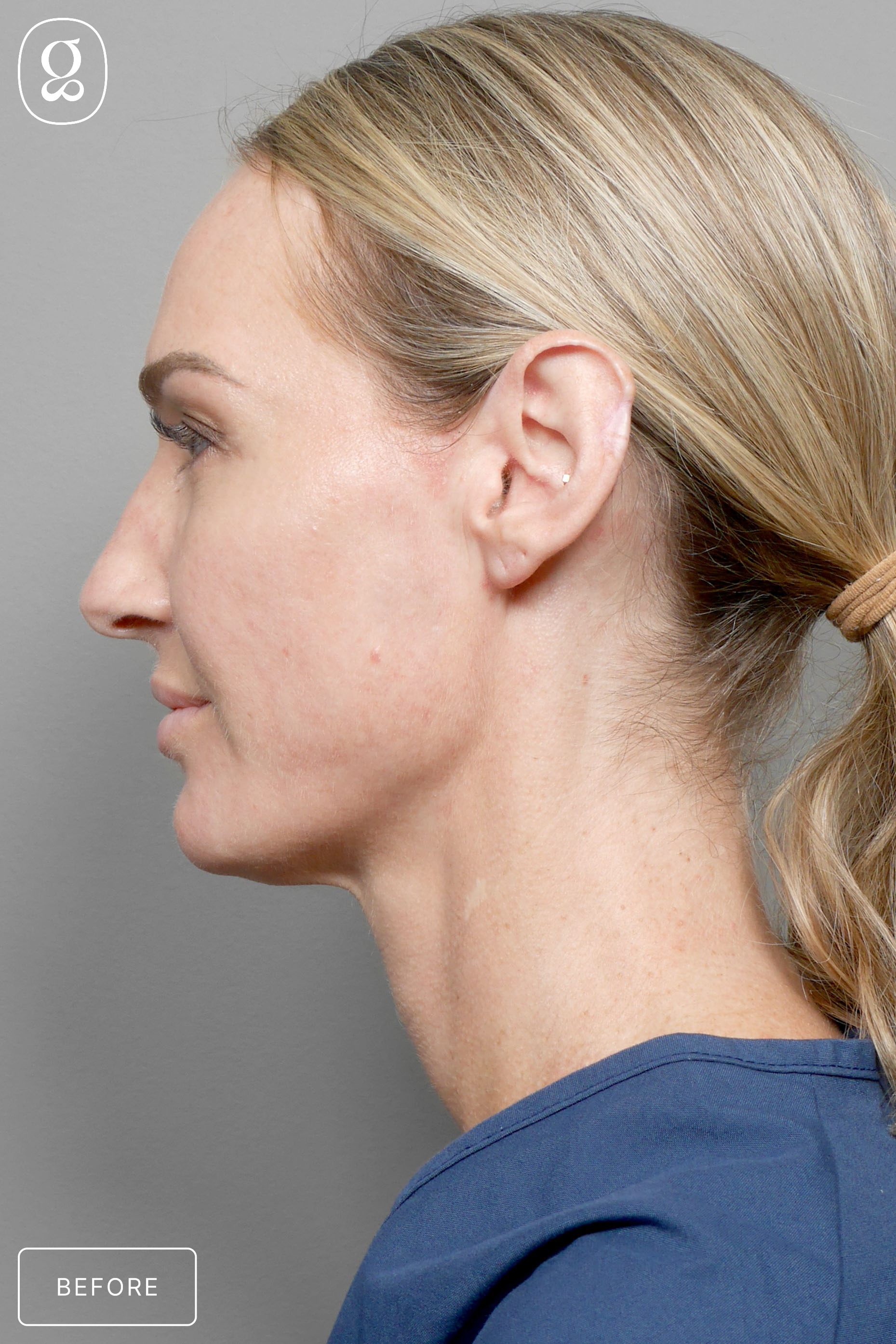 Facelift before photo