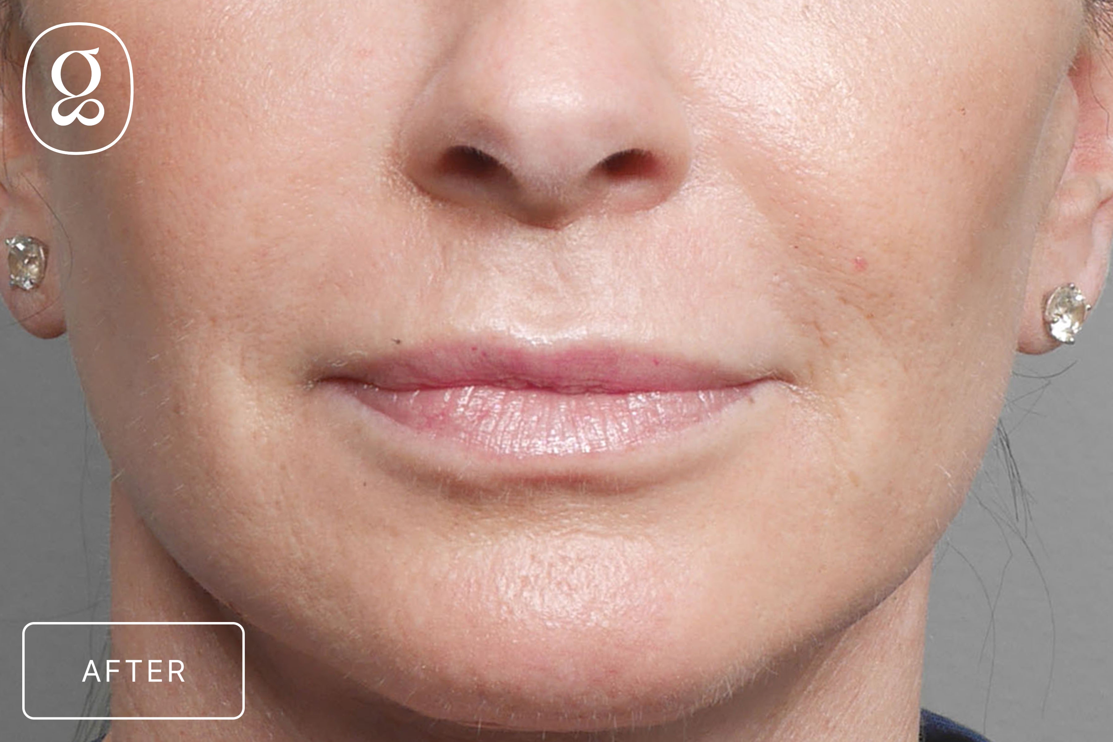 Lip Lift result at Gould Aesthetics