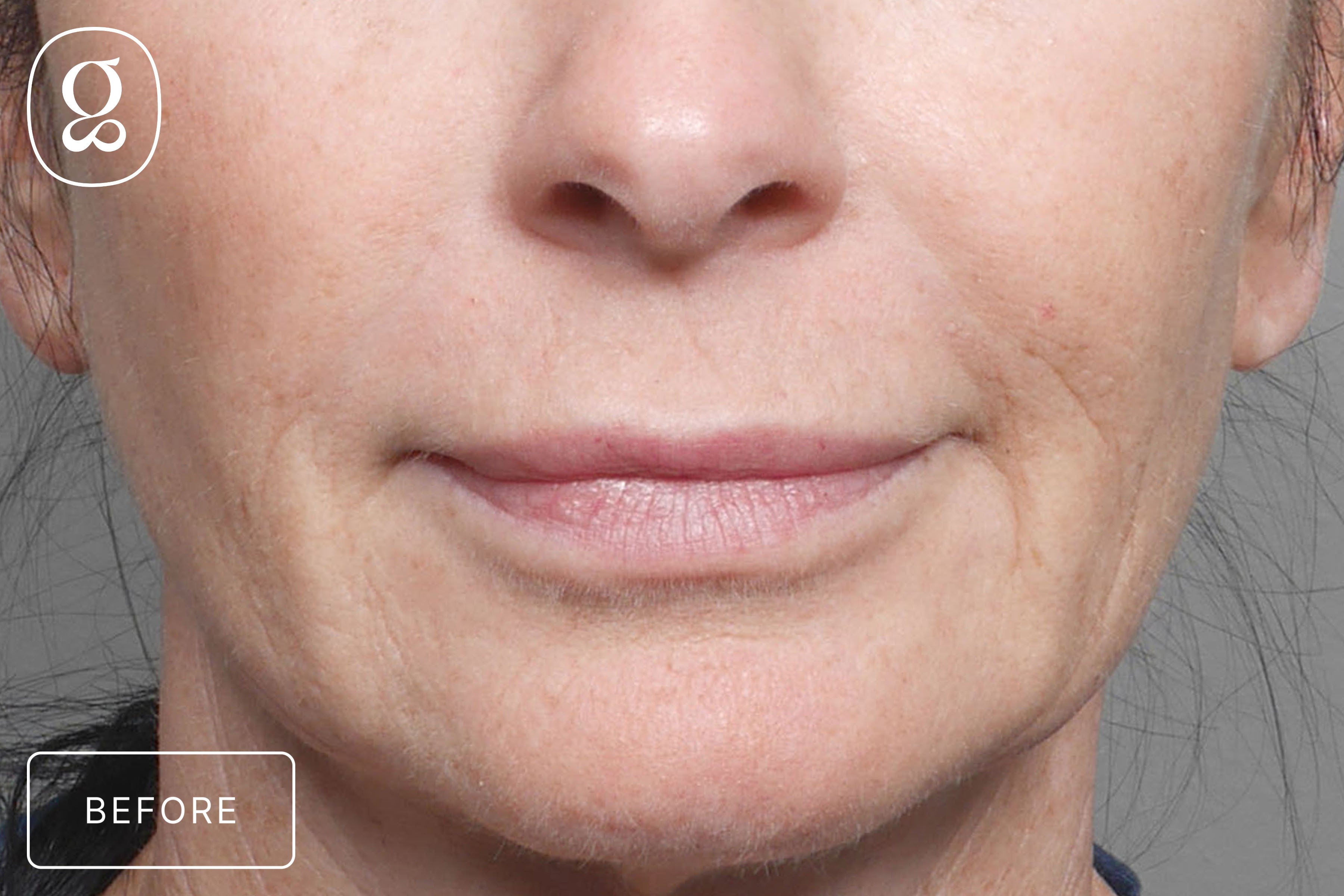 Lip Lift before photo