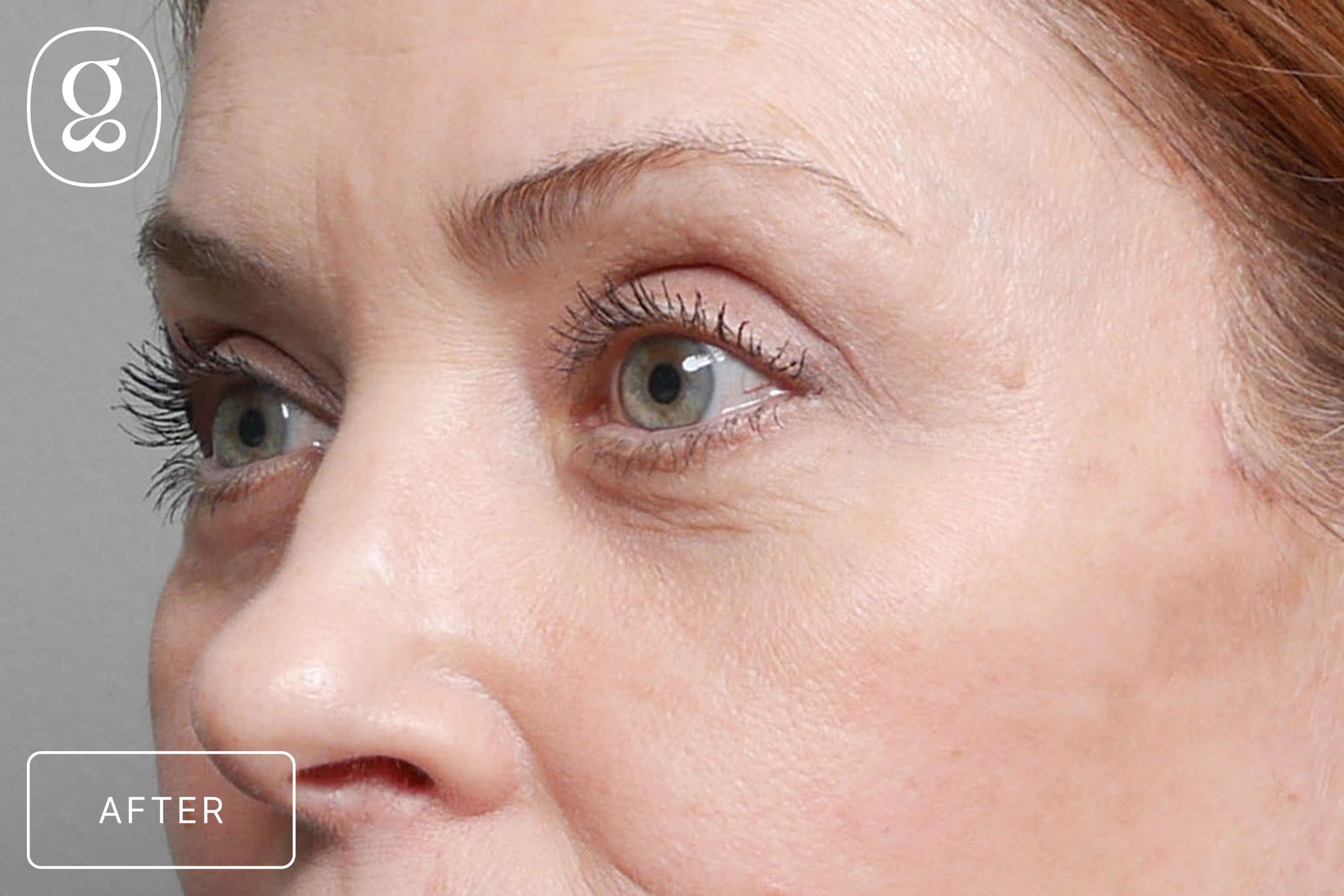 Brow Lift result at Gould Aesthetics