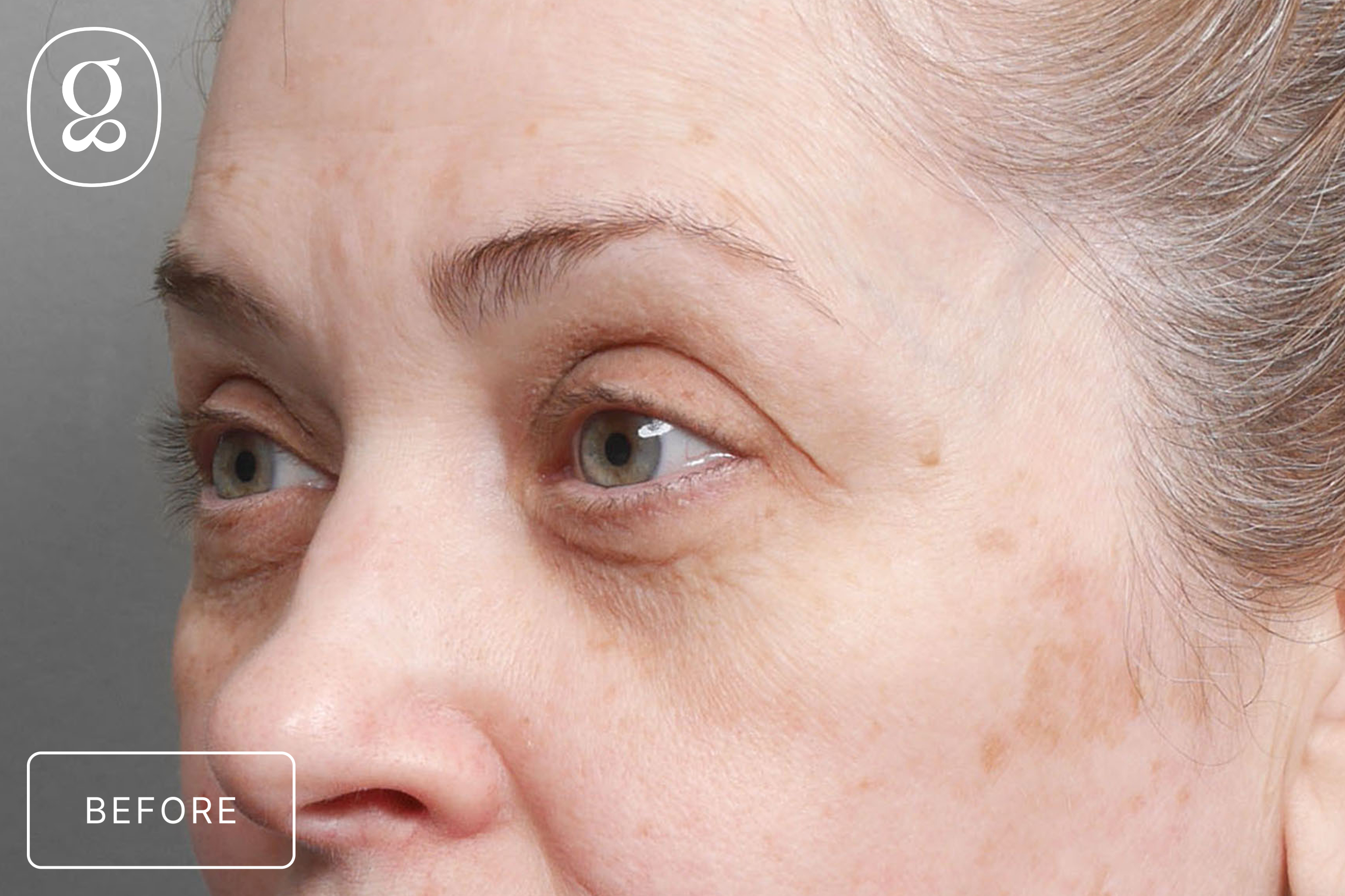 Brow Lift before photo