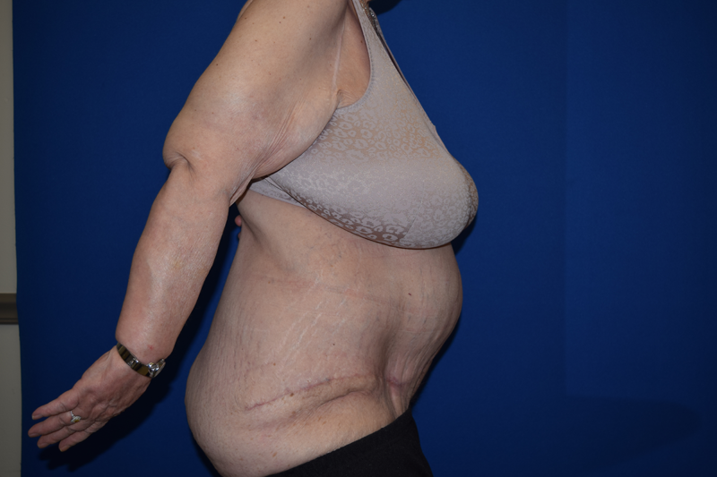 A result from DePerro Plastic Surgery