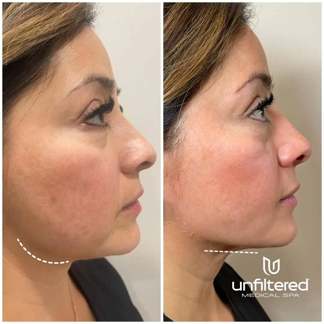 A result from Unfiltered Medical Spa