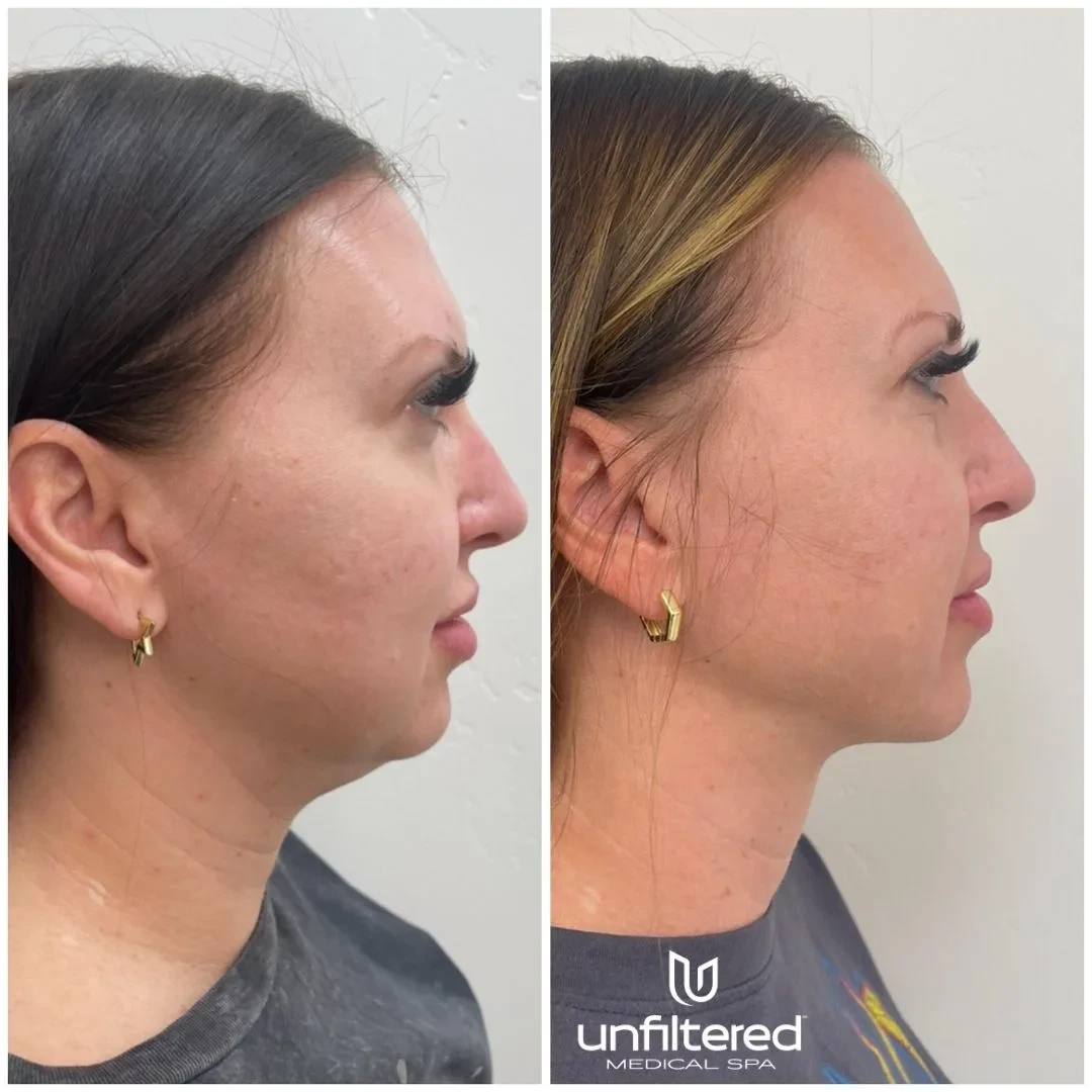 A result from Unfiltered Medical Spa