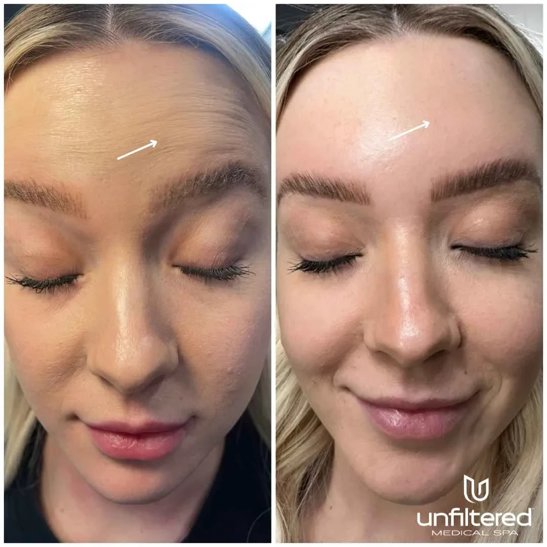 A result from Unfiltered Medical Spa