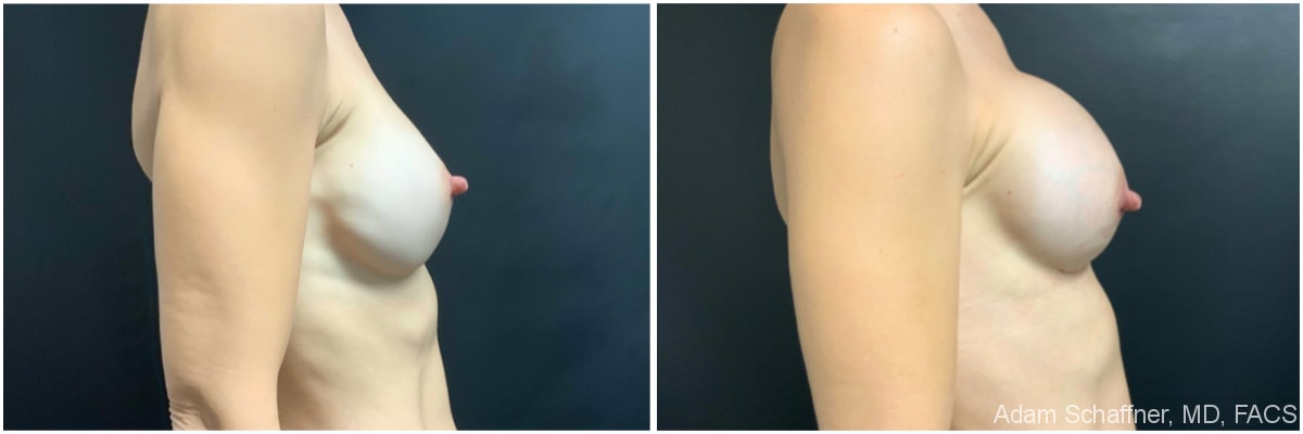 A result from Adam Schaffner, MD, FACS