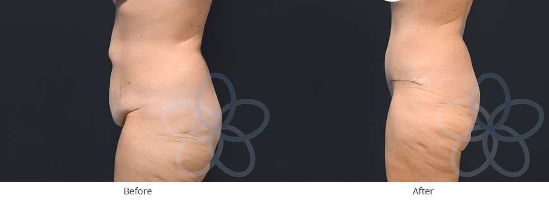 A result from Newvue Plastic Surgery
