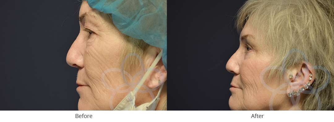 A result from Newvue Plastic Surgery
