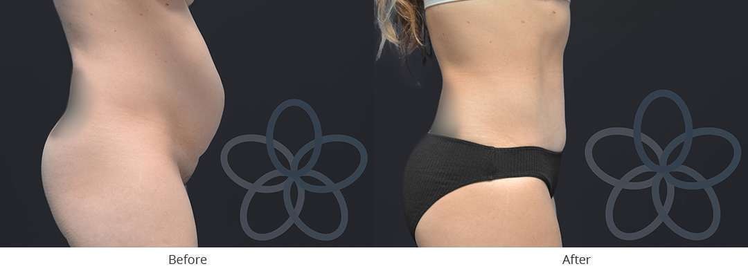 A result from Newvue Plastic Surgery