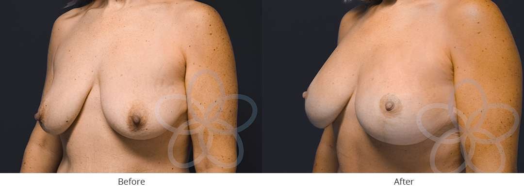 A result from Newvue Plastic Surgery