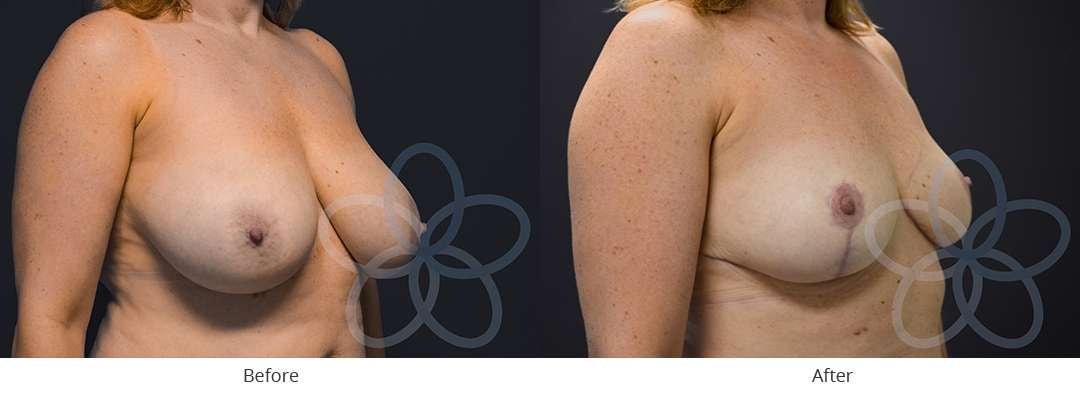 A result from Newvue Plastic Surgery