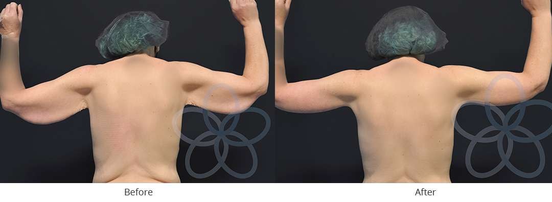 A result from Newvue Plastic Surgery
