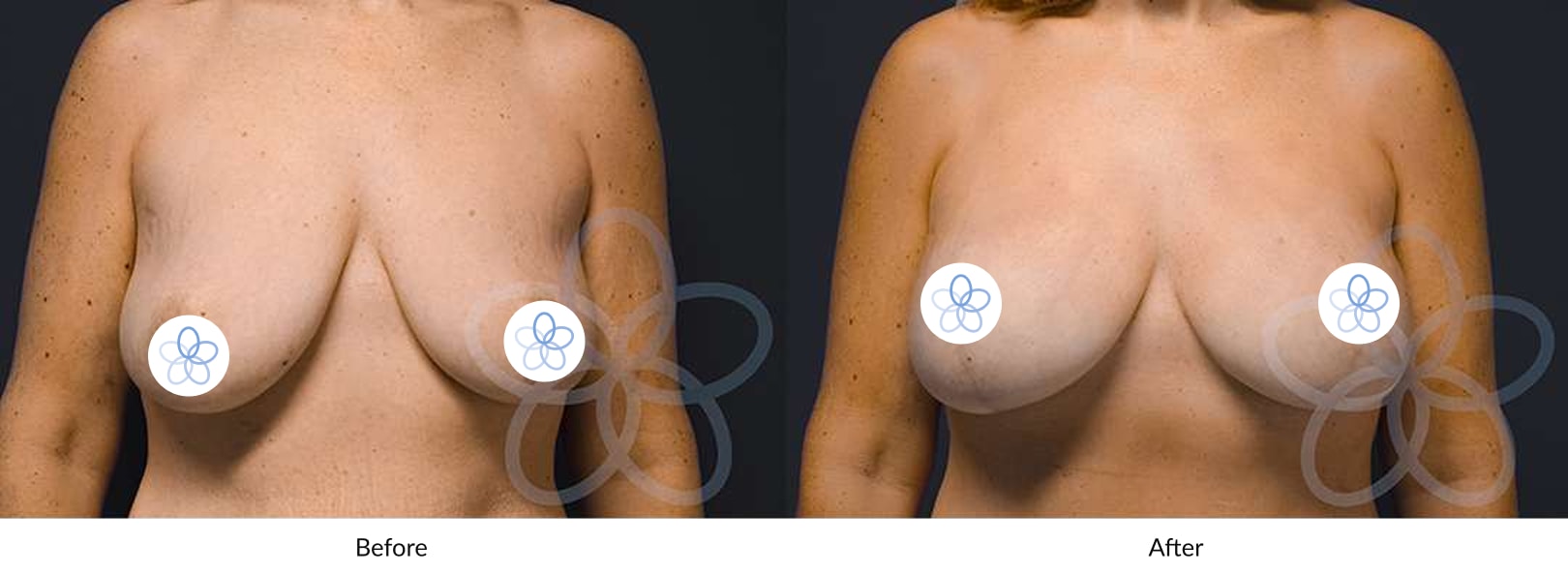 A result from Newvue Plastic Surgery