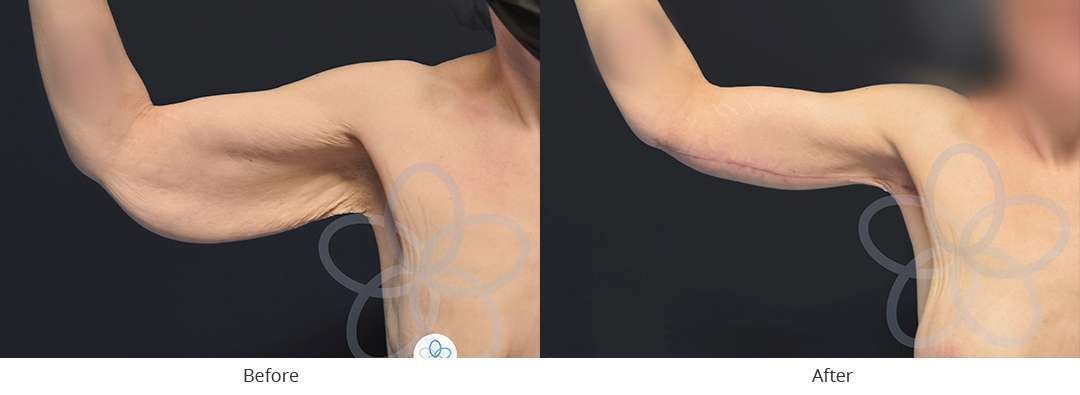 A result from Newvue Plastic Surgery