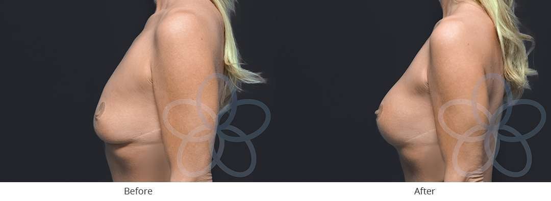 A result from Newvue Plastic Surgery