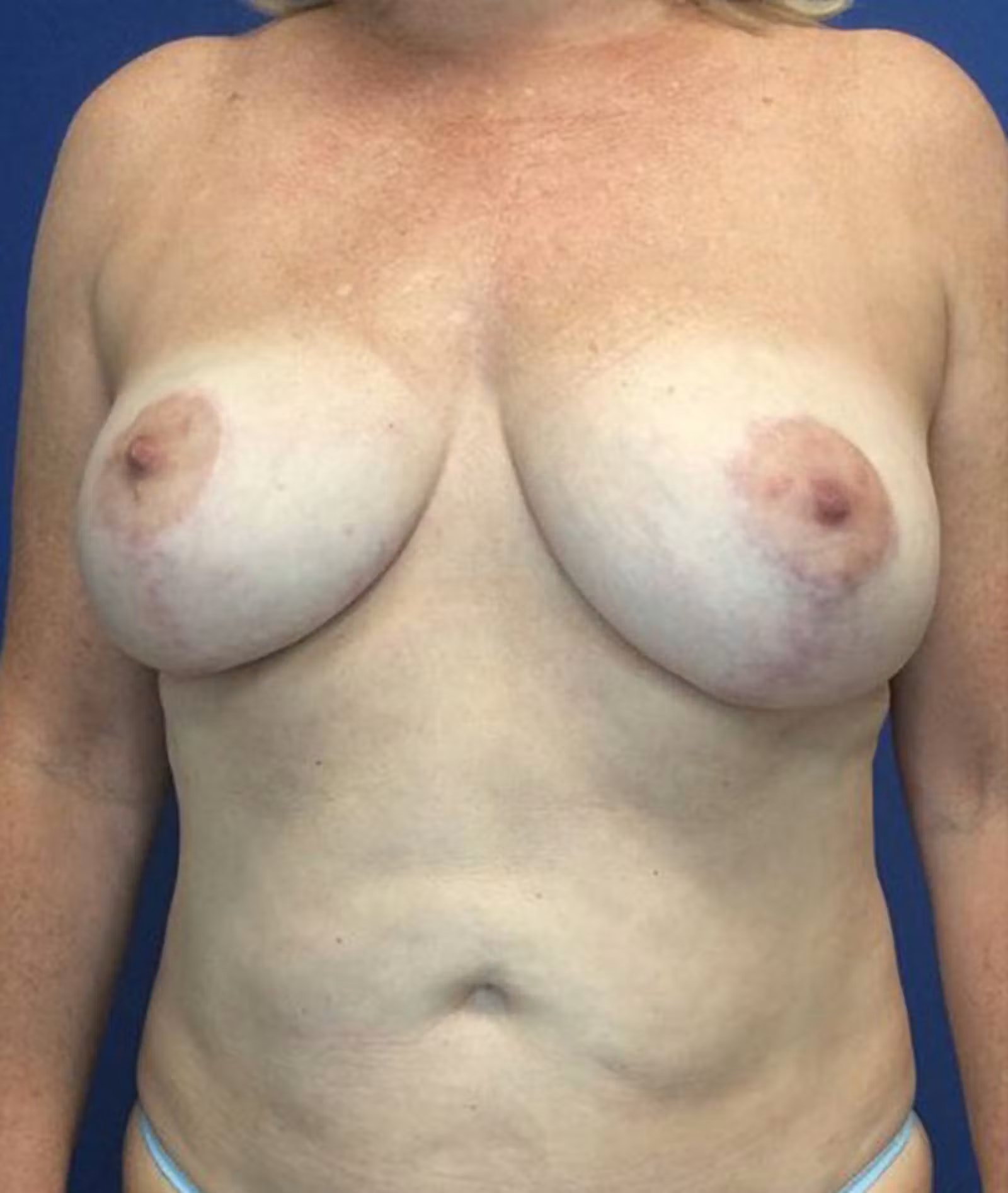 A result from Richmond Plastic Surgeons