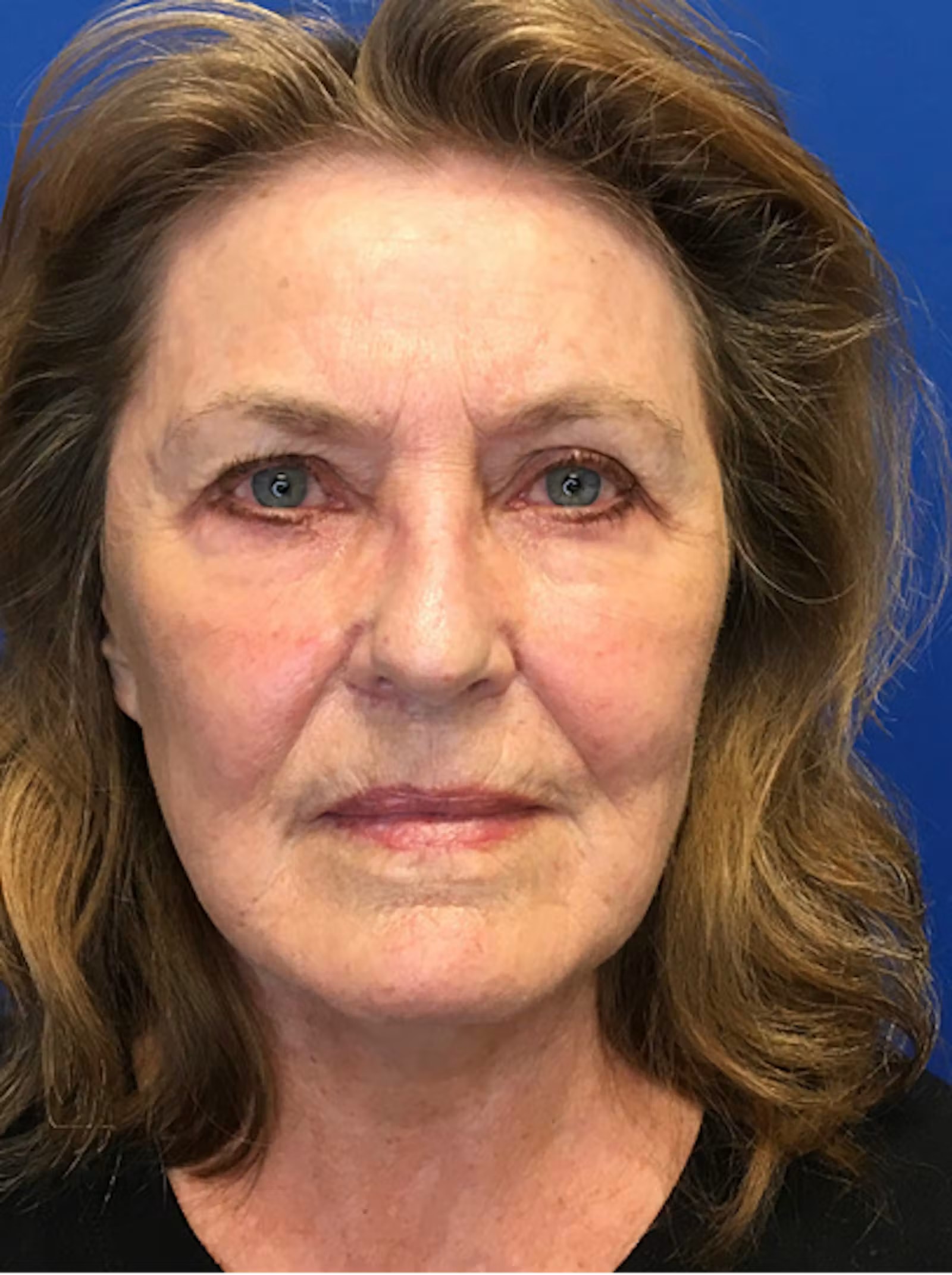 A result from Richmond Plastic Surgeons