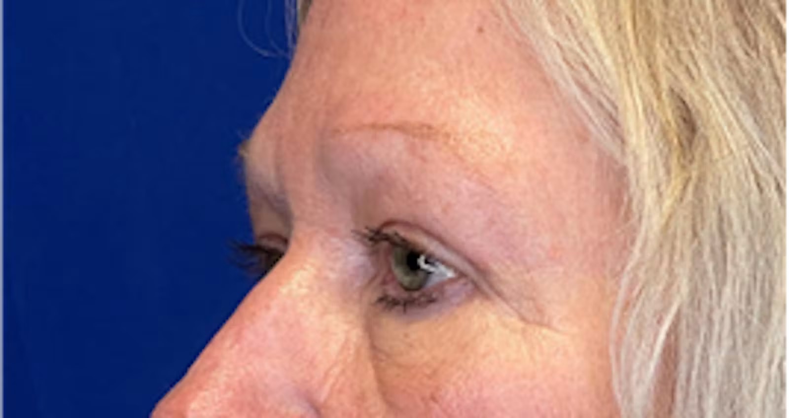 A result from Richmond Plastic Surgeons