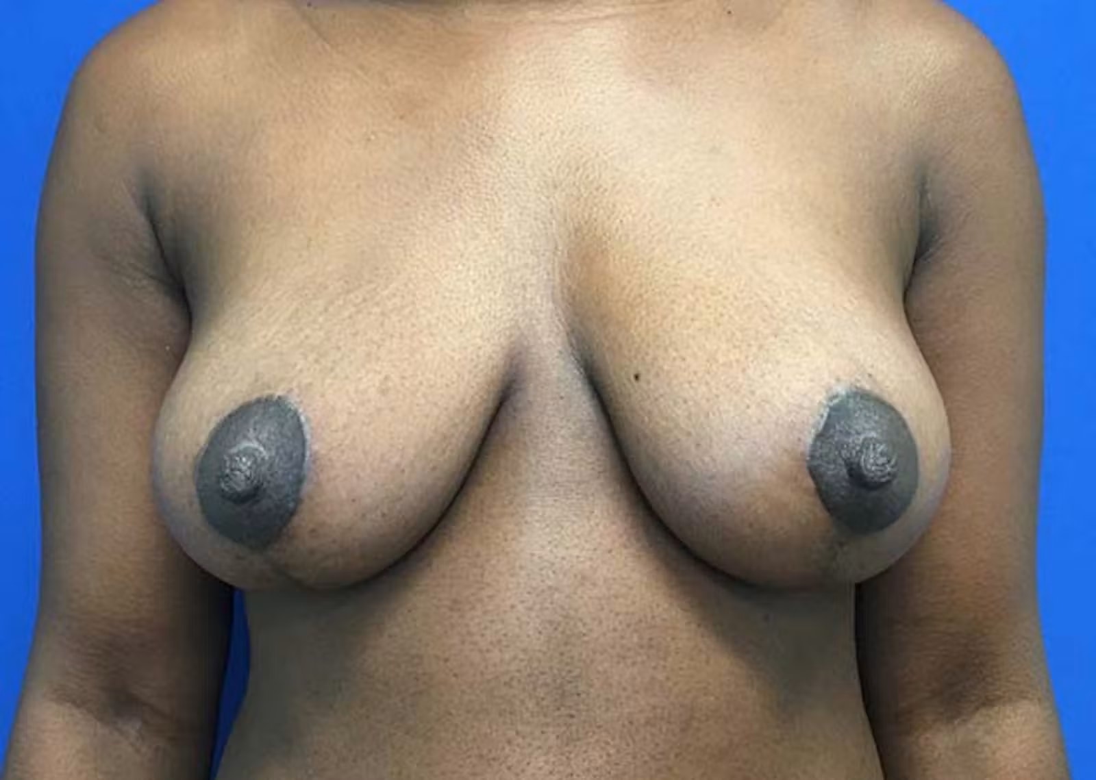 A result from Richmond Plastic Surgeons