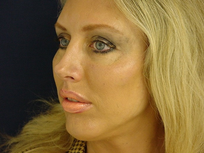 A result from Mira Aesthetic Cosmetic Surgery Center - Dr. Mirrafati