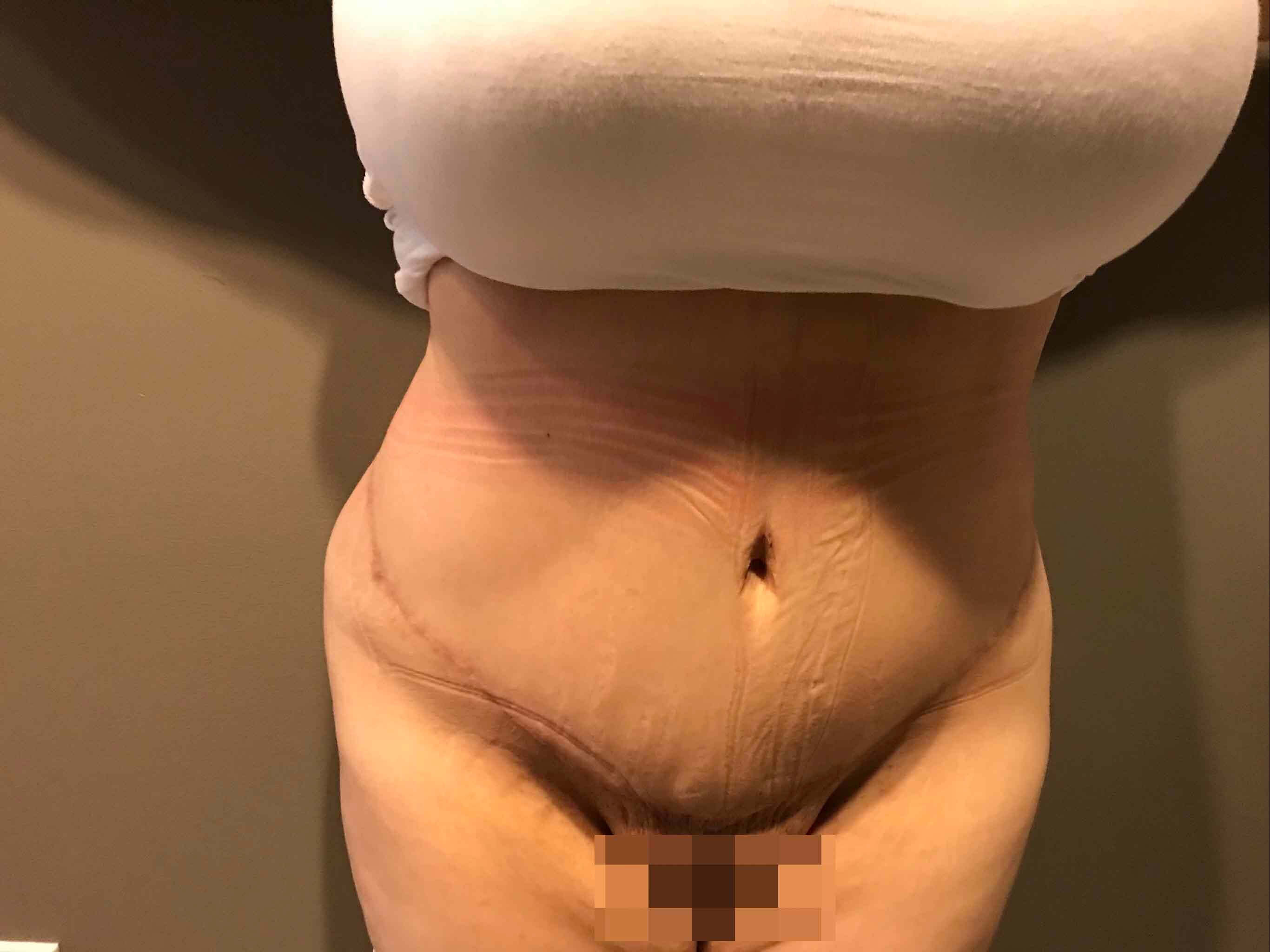 A result from Mira Aesthetic Cosmetic Surgery Center - Dr. Mirrafati