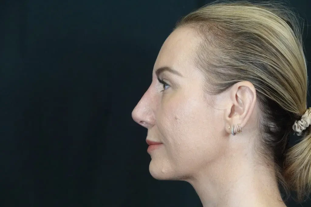 A result from Mira Aesthetic Cosmetic Surgery Center - Dr. Mirrafati