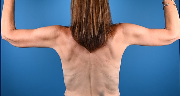 A result from Plastic Surgery Clinic of Chicago
