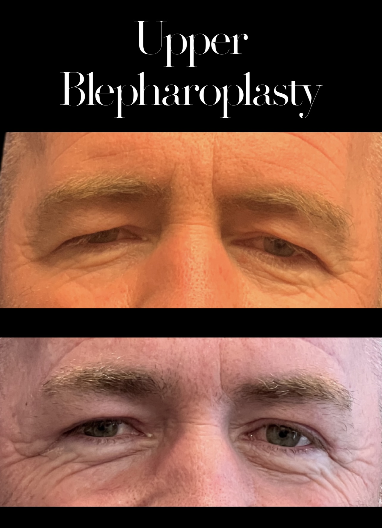 Blepharoplasty result at PEAK PLASTIC SURGERY