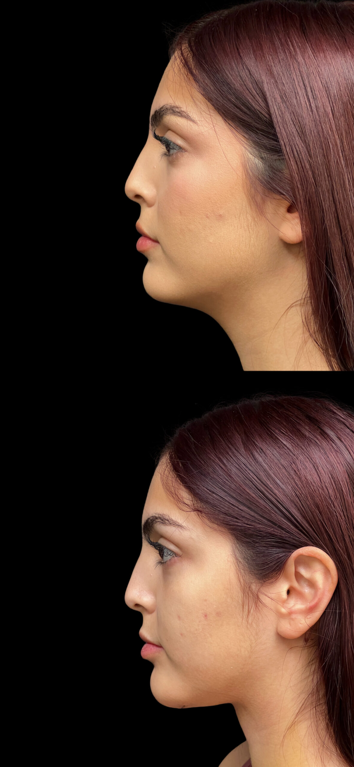 Neck Lift result at PEAK PLASTIC SURGERY