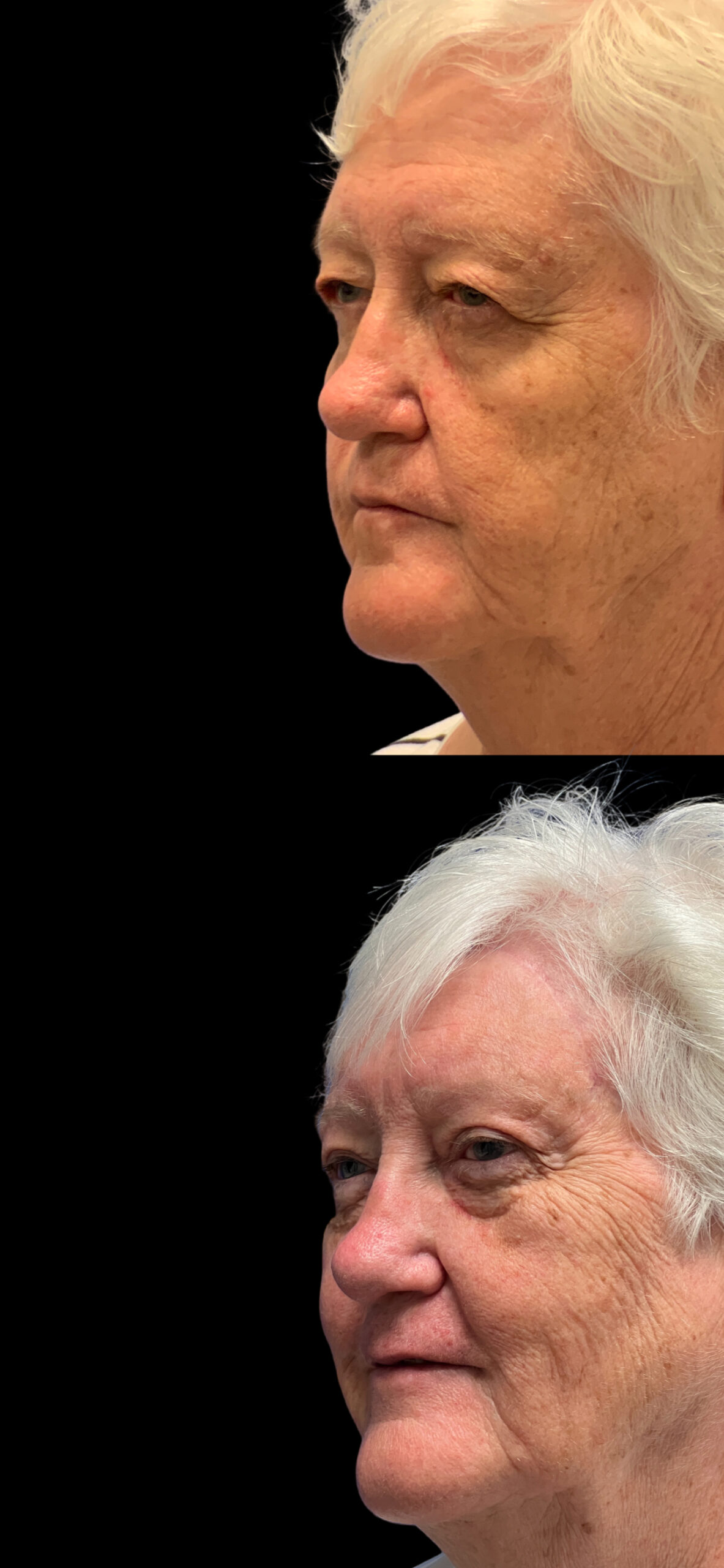 Brow Lift result at PEAK PLASTIC SURGERY