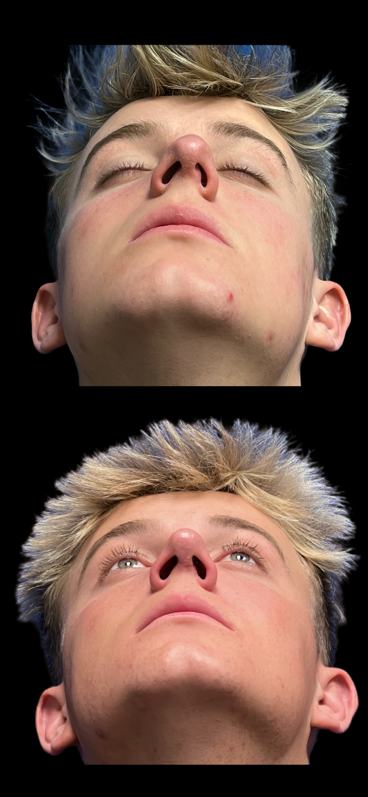 Rhinoplasty result at PEAK PLASTIC SURGERY
