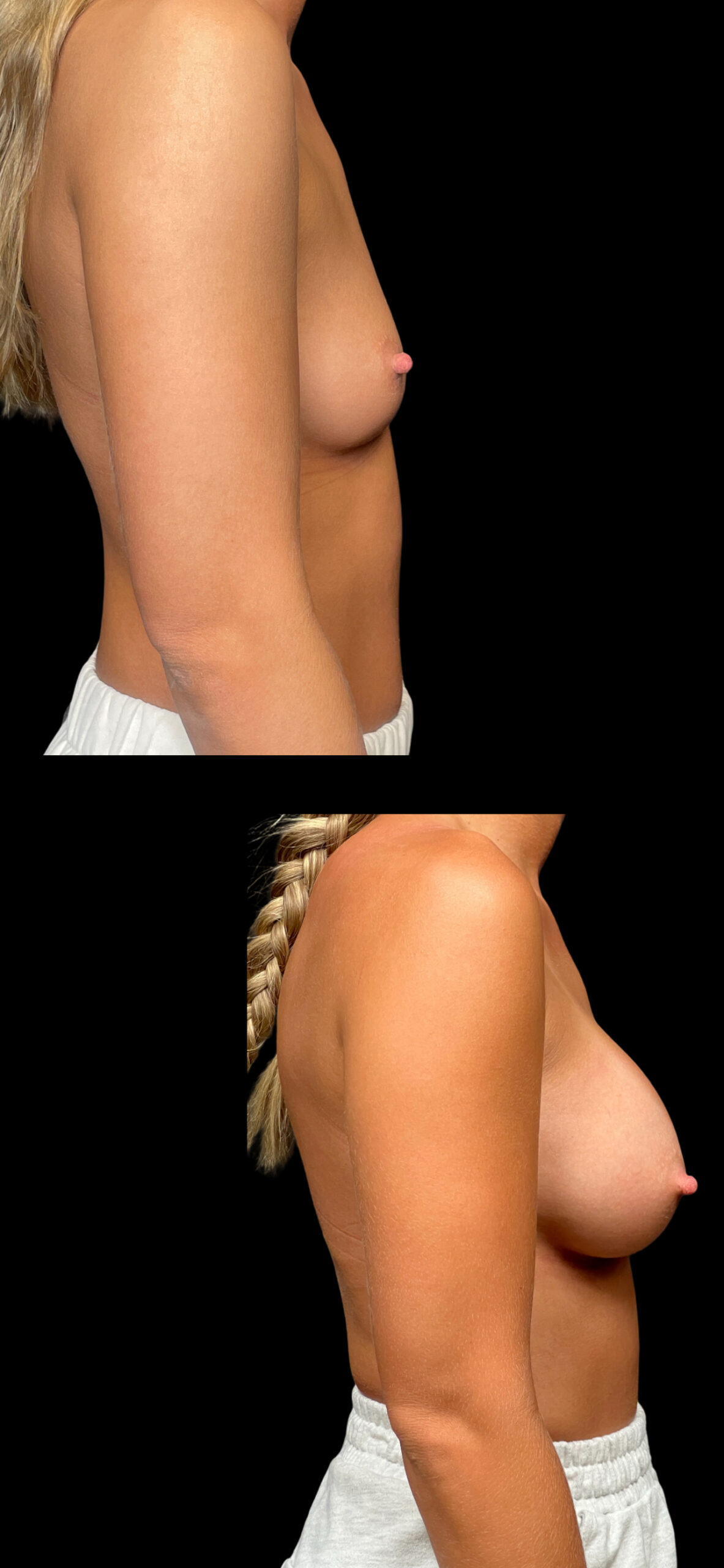 Breast Augmentation result at PEAK PLASTIC SURGERY