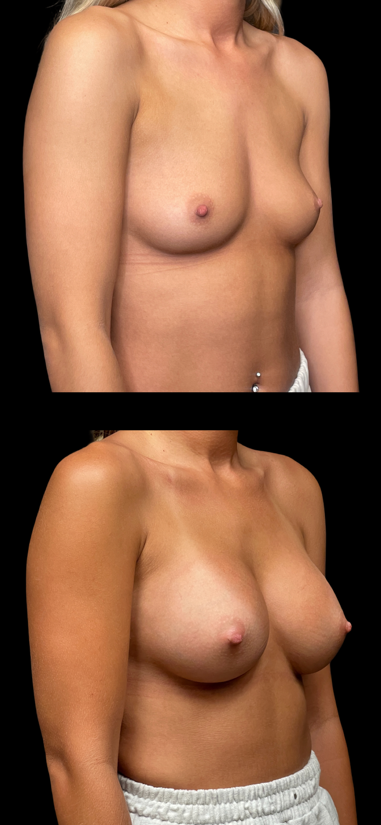 Breast Augmentation result at PEAK PLASTIC SURGERY