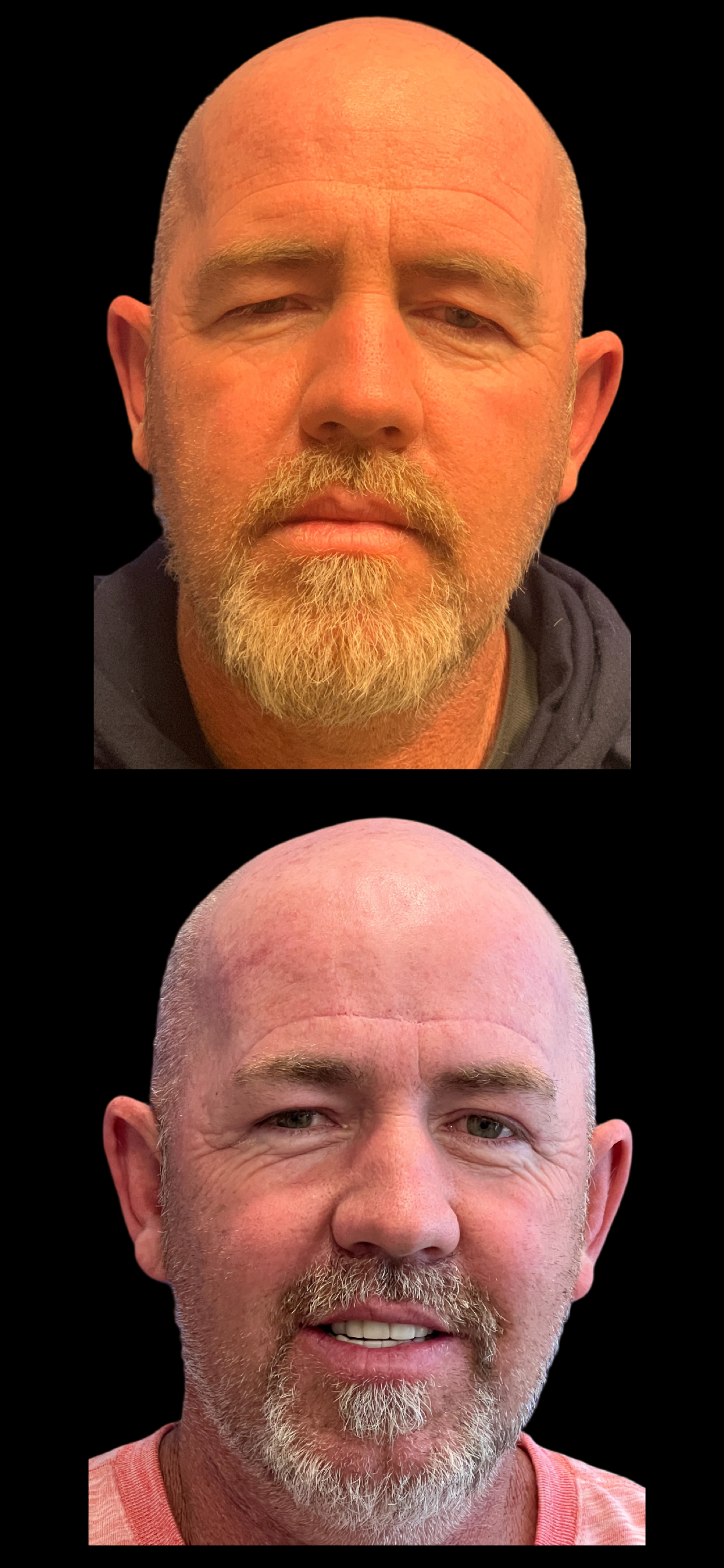 Brow Lift result at PEAK PLASTIC SURGERY