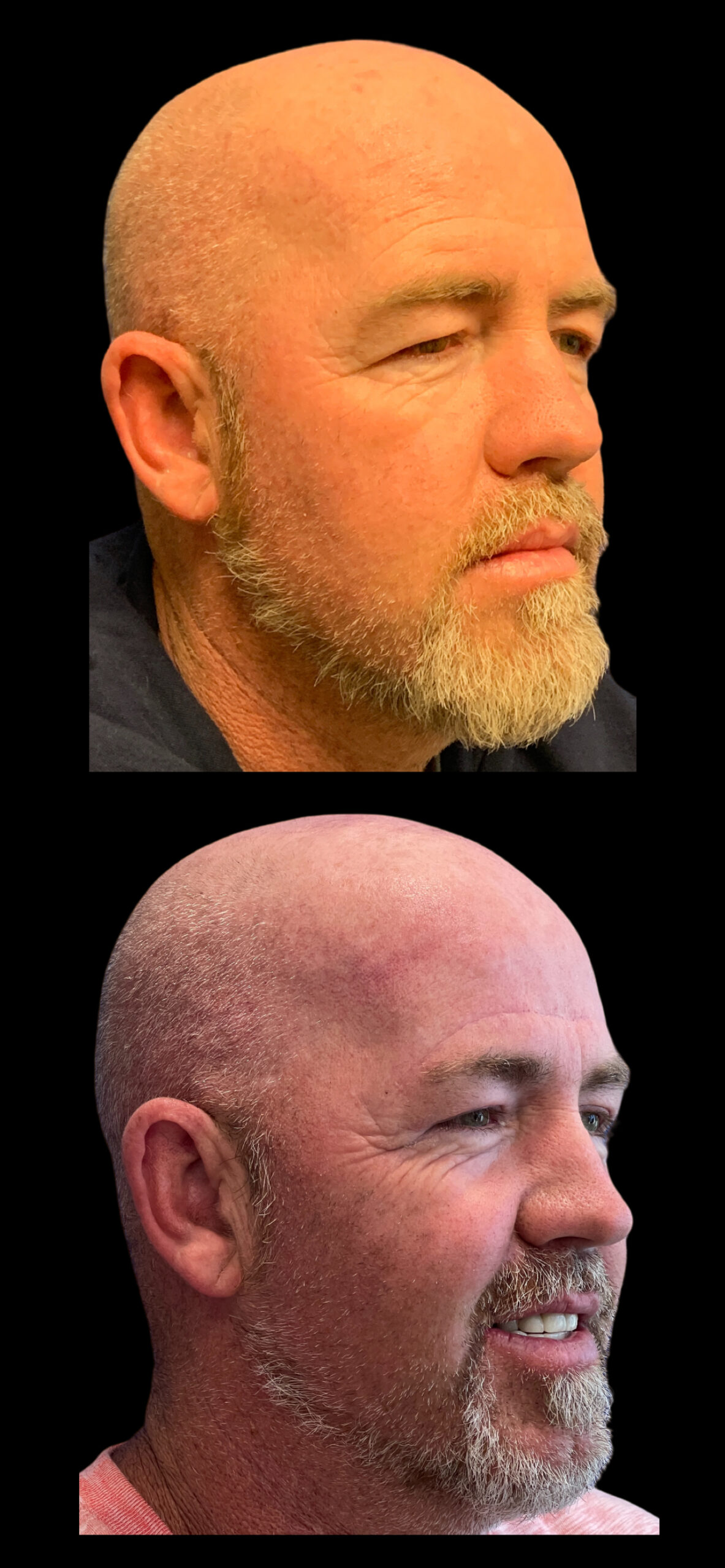 Brow Lift result at PEAK PLASTIC SURGERY