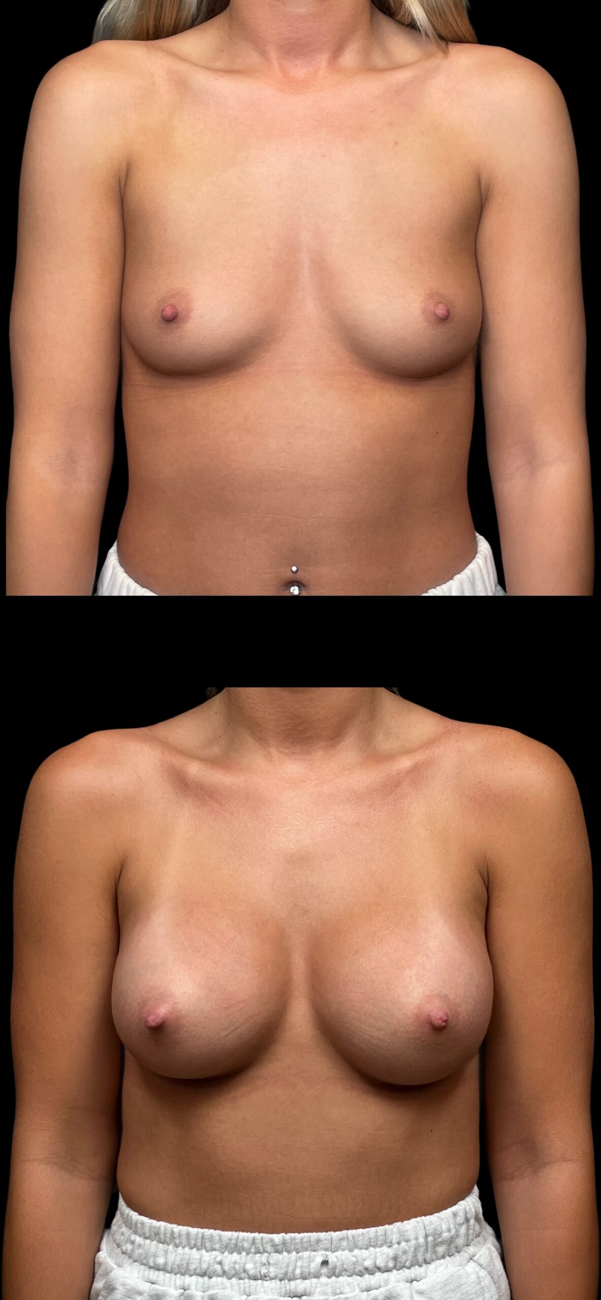 Breast Augmentation result at PEAK PLASTIC SURGERY