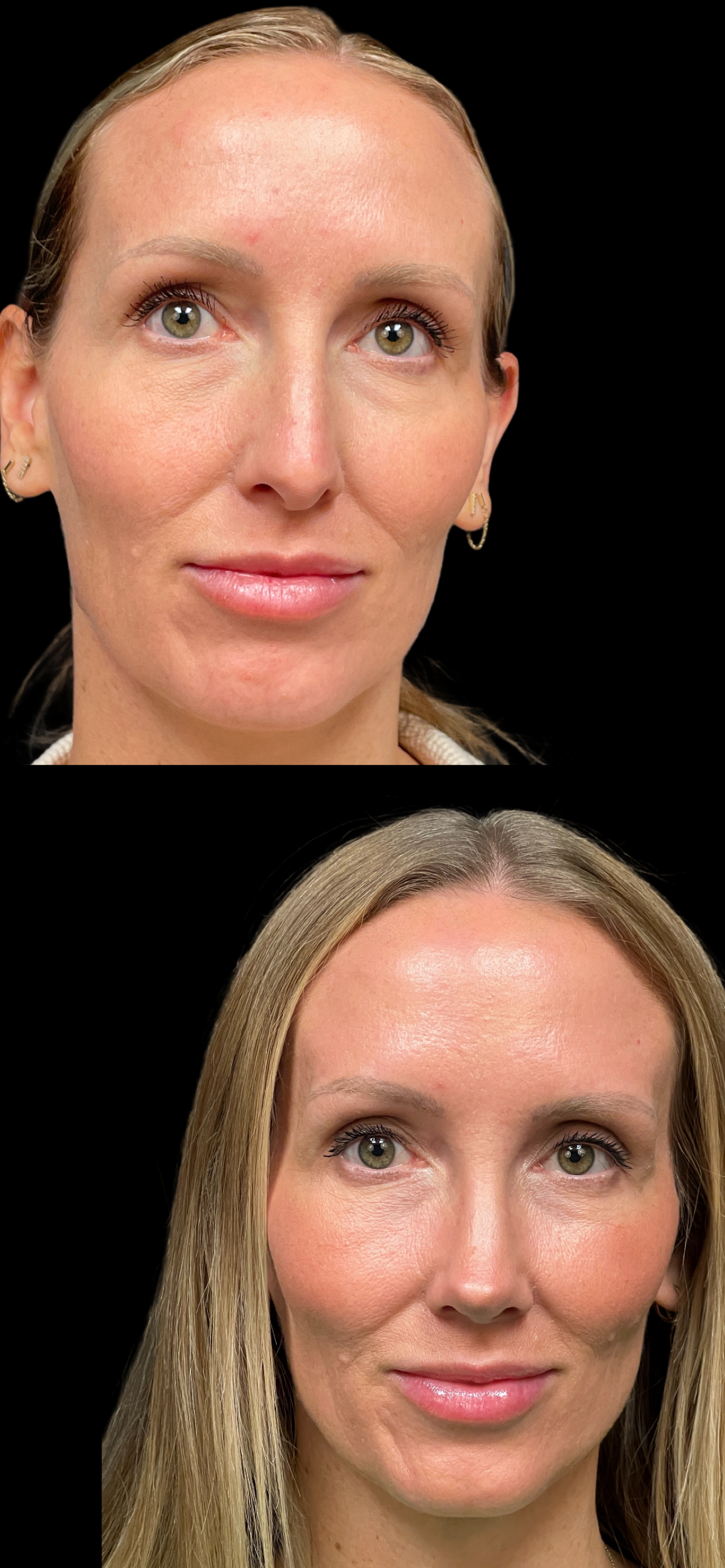 Rhinoplasty result at PEAK PLASTIC SURGERY