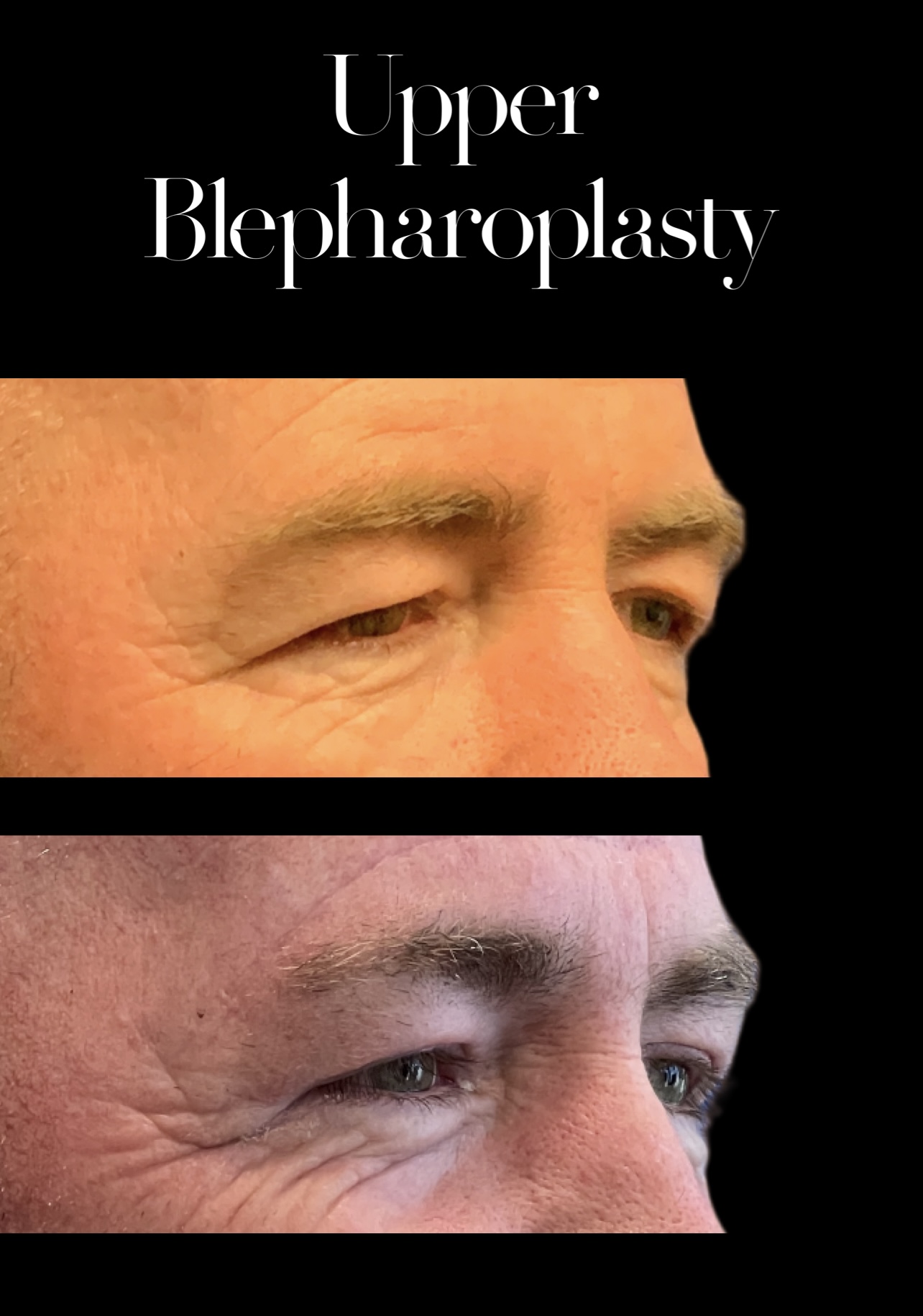 Blepharoplasty result at PEAK PLASTIC SURGERY