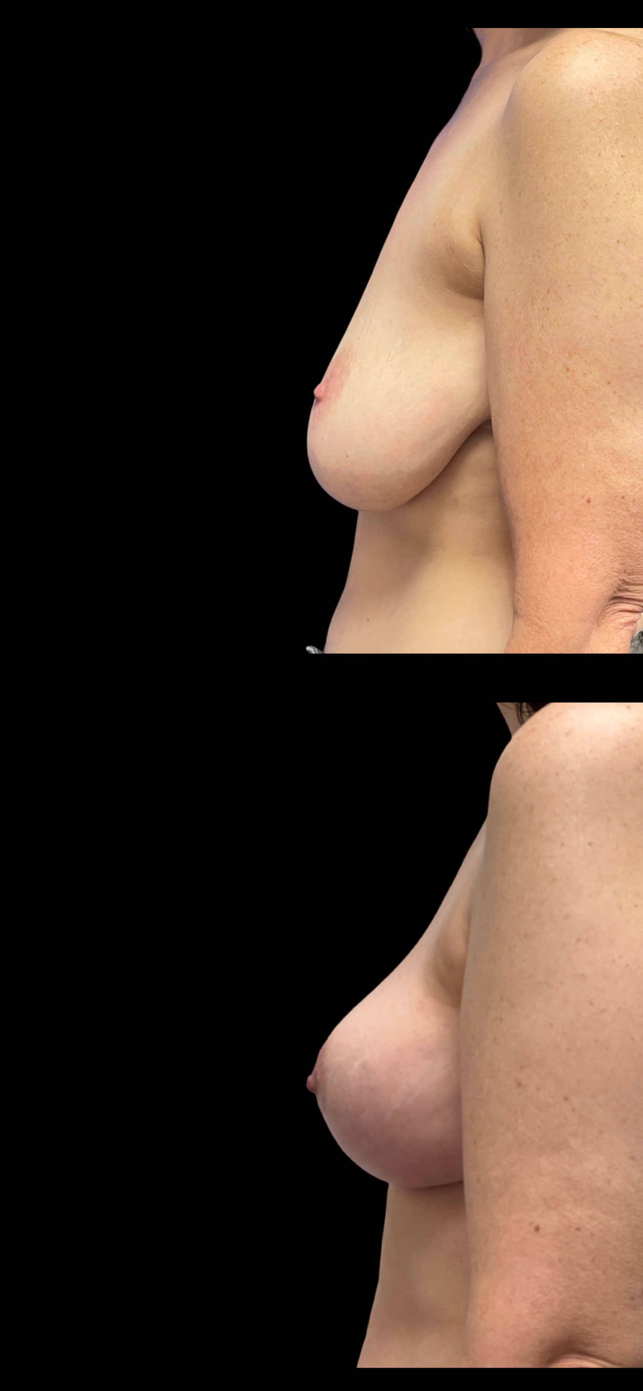 Breast Reduction result at PEAK PLASTIC SURGERY