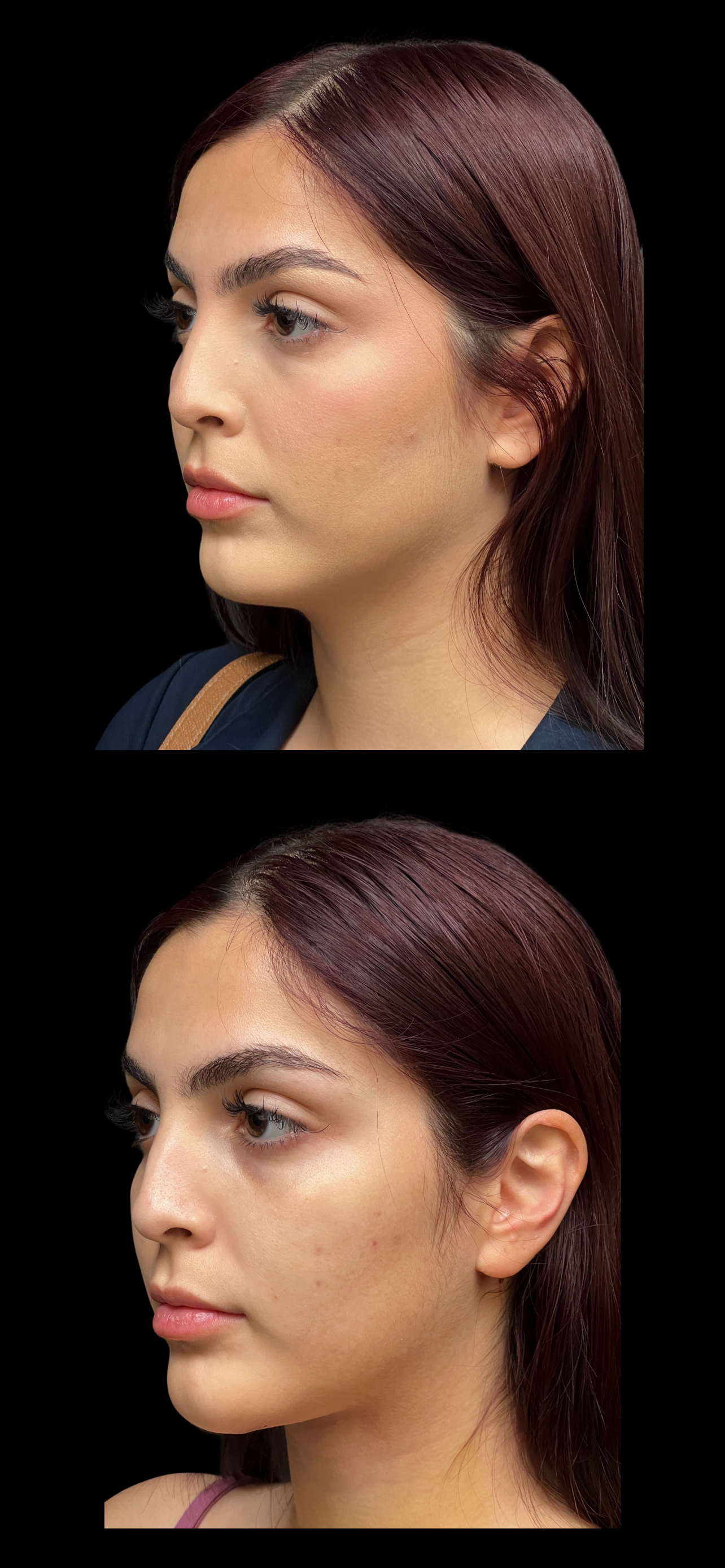 Neck Lift result at PEAK PLASTIC SURGERY