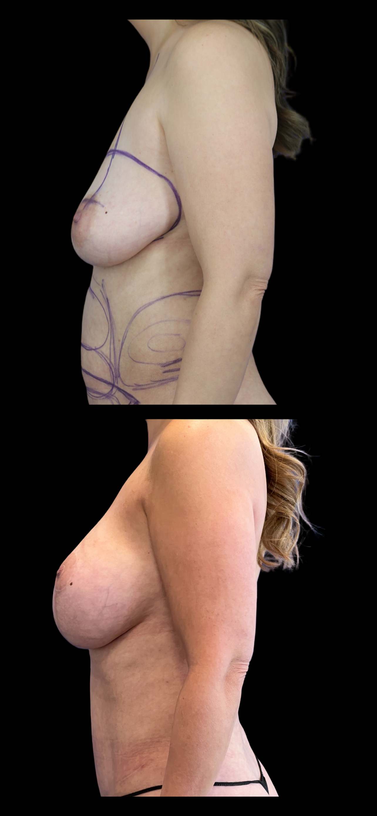 Breast Lift result at PEAK PLASTIC SURGERY