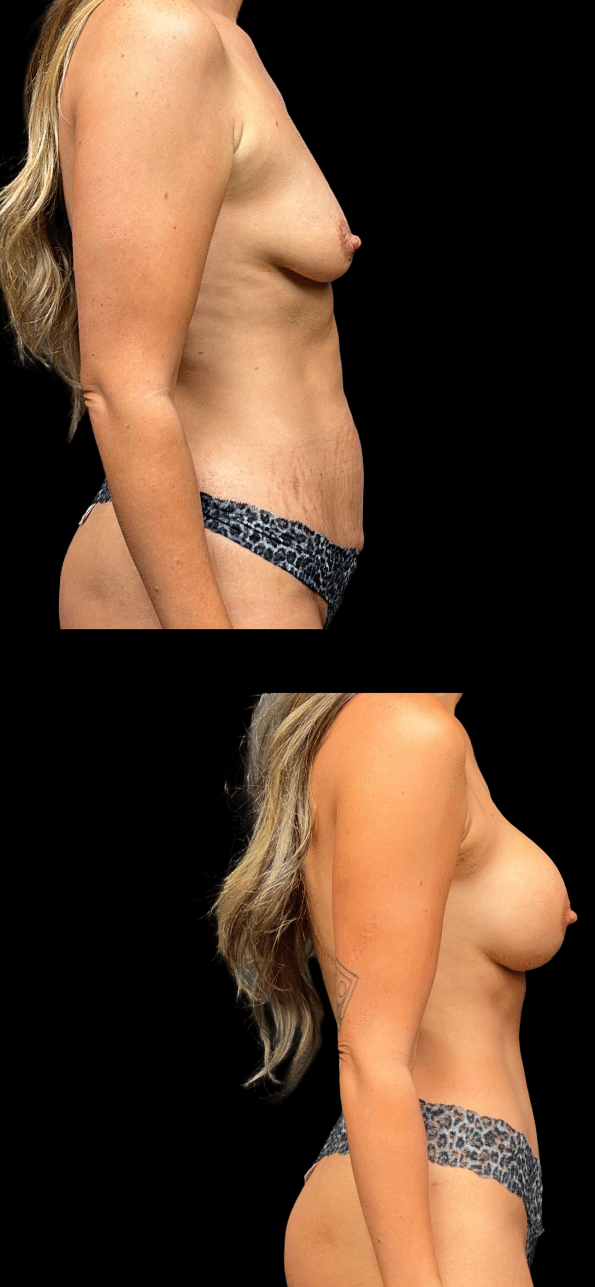 Mommy Makeover result at PEAK PLASTIC SURGERY