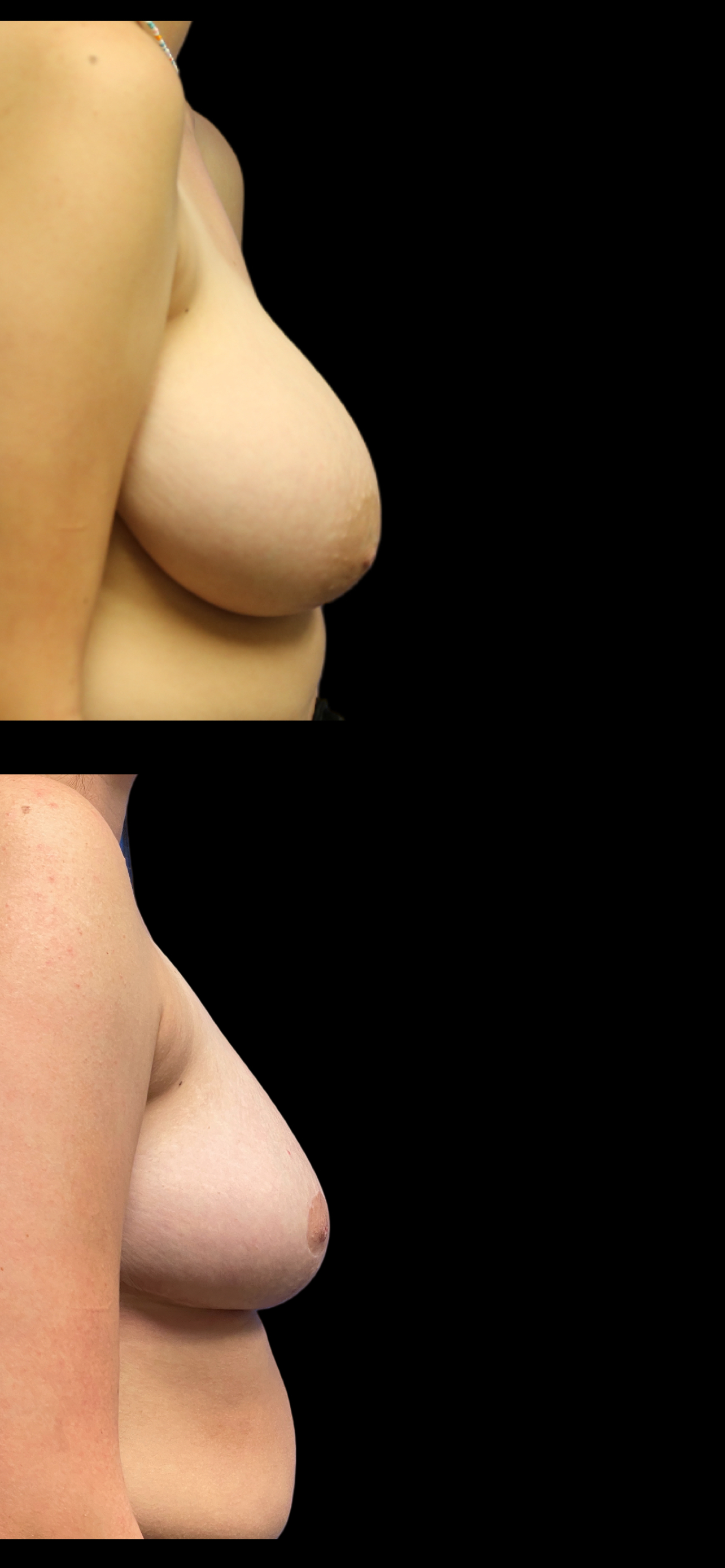 Breast Reduction result at PEAK PLASTIC SURGERY